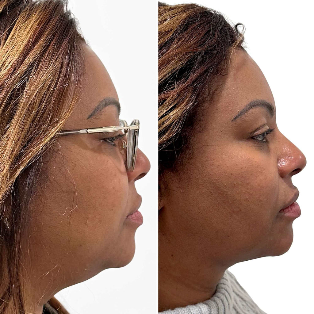 ChinFix: Liposuction – Beauty Fix MedSpa