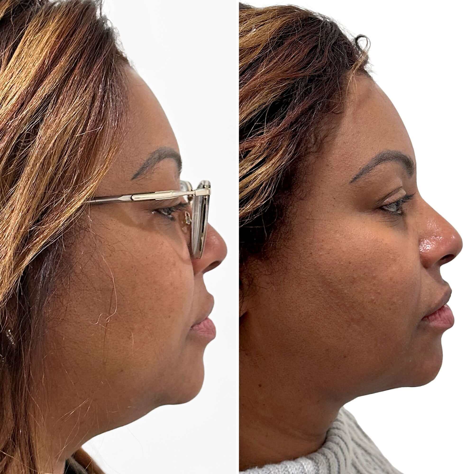 ChinFix: Liposuction – Beauty Fix MedSpa