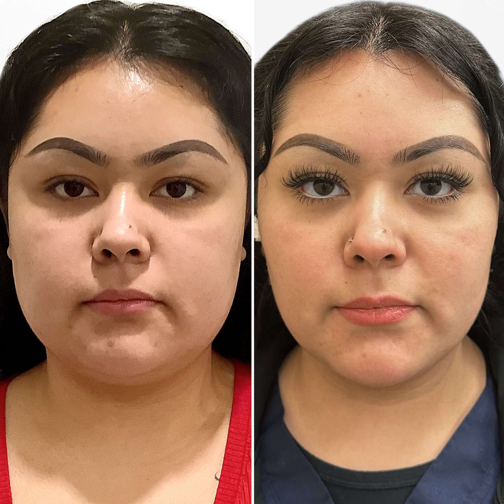 CheekFix: Buccal Fat Reduction – Beauty Fix MedSpa