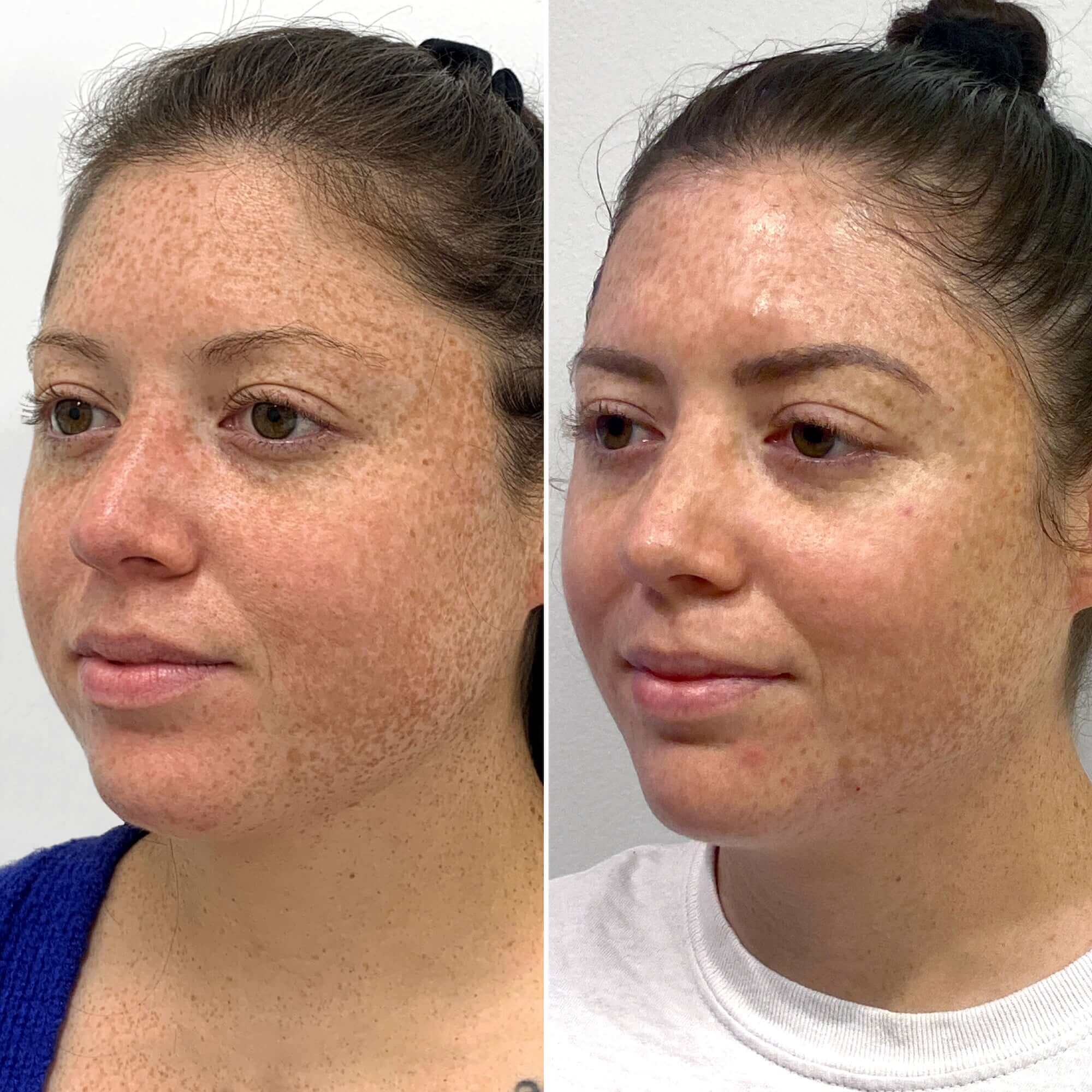 CheekFix: Buccal Fat Reduction – Beauty Fix MedSpa