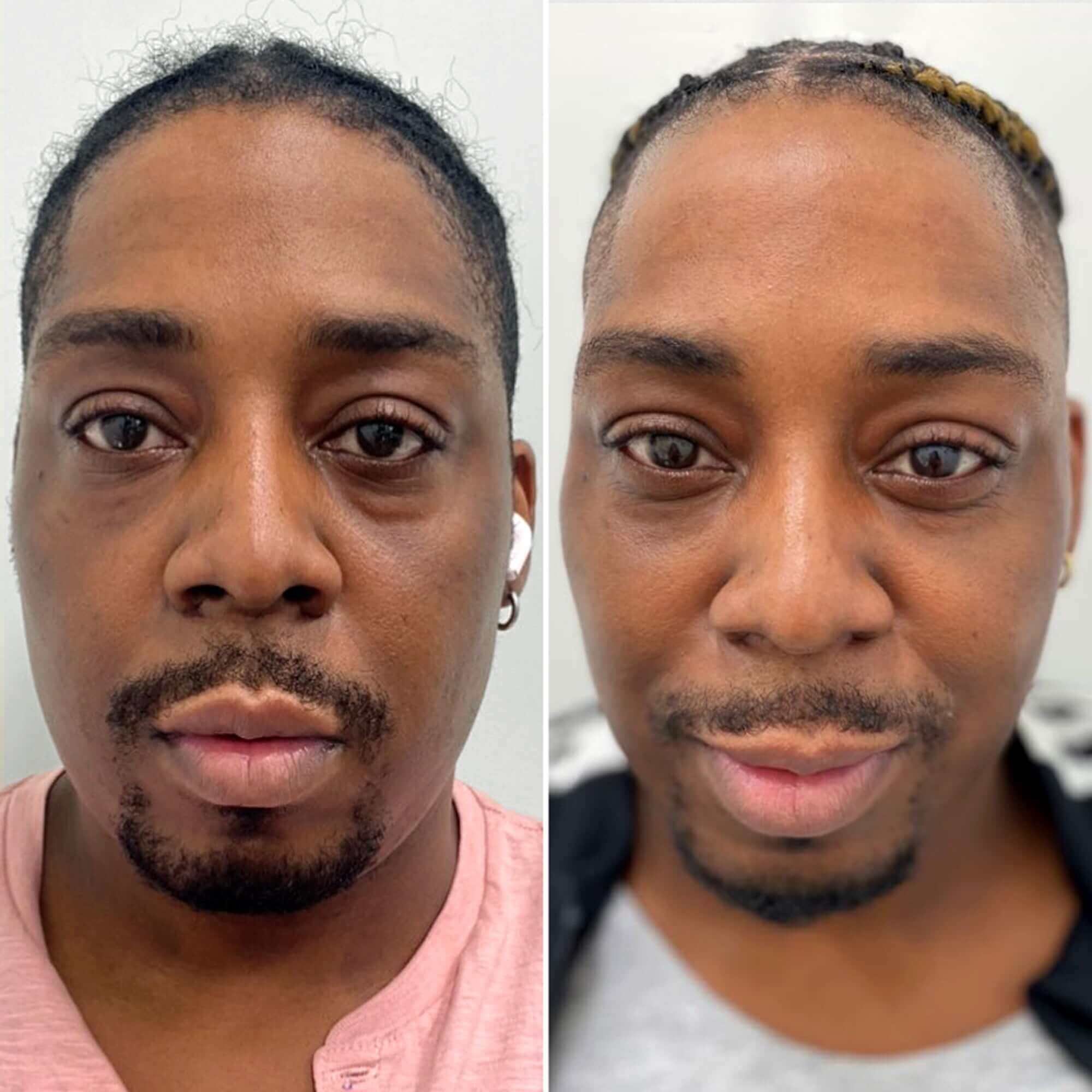 CheekFix: Buccal Fat Reduction – Beauty Fix MedSpa