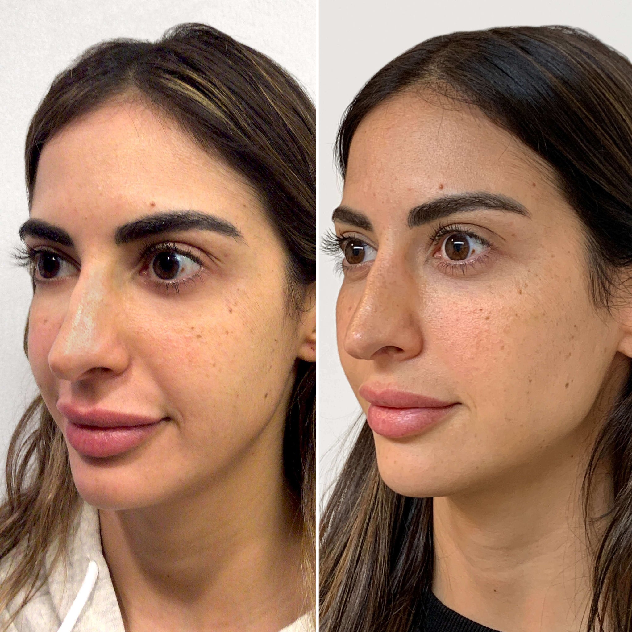 CheekFix: Buccal Fat Reduction – Beauty Fix MedSpa