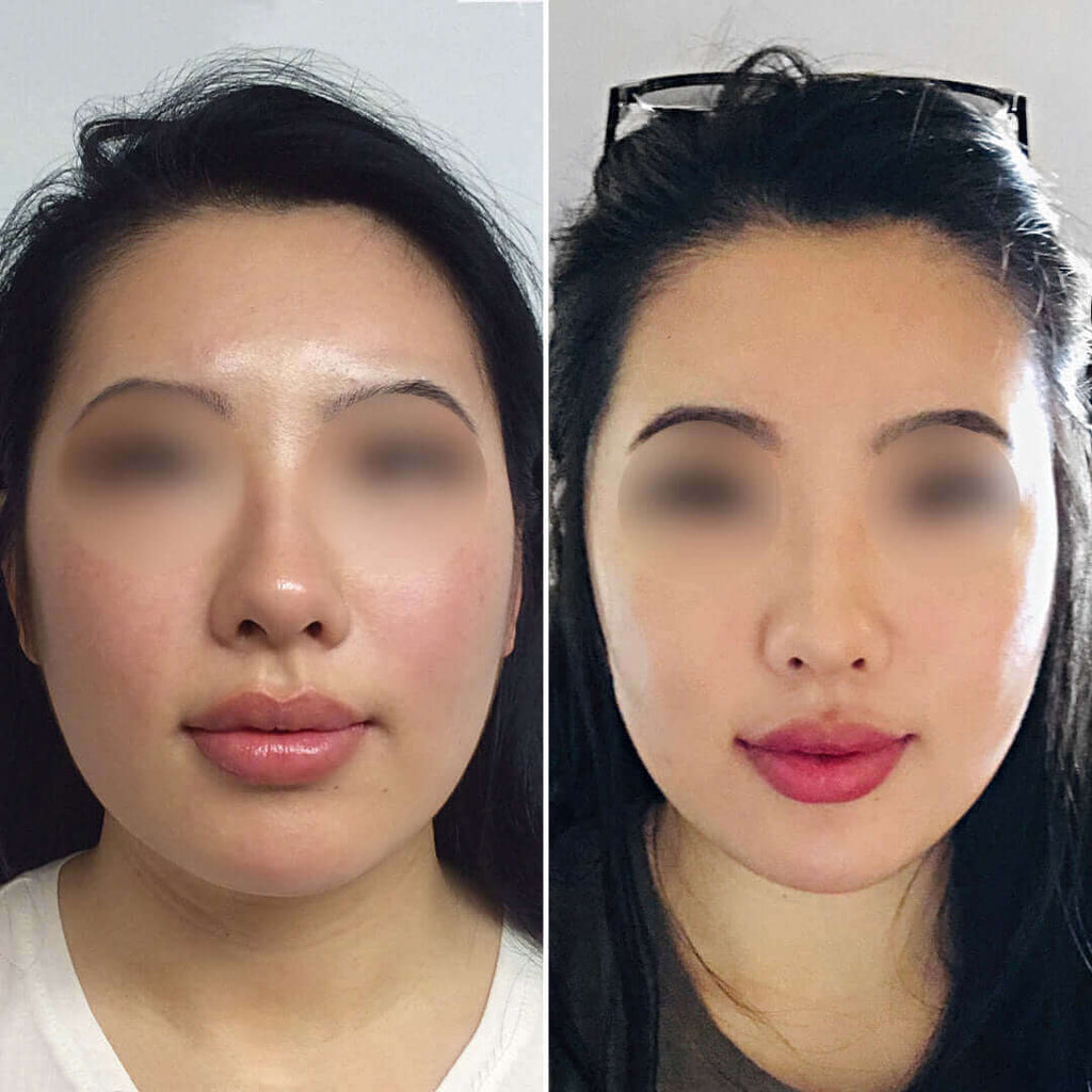 CheekFix: Buccal Fat Reduction – Beauty Fix MedSpa