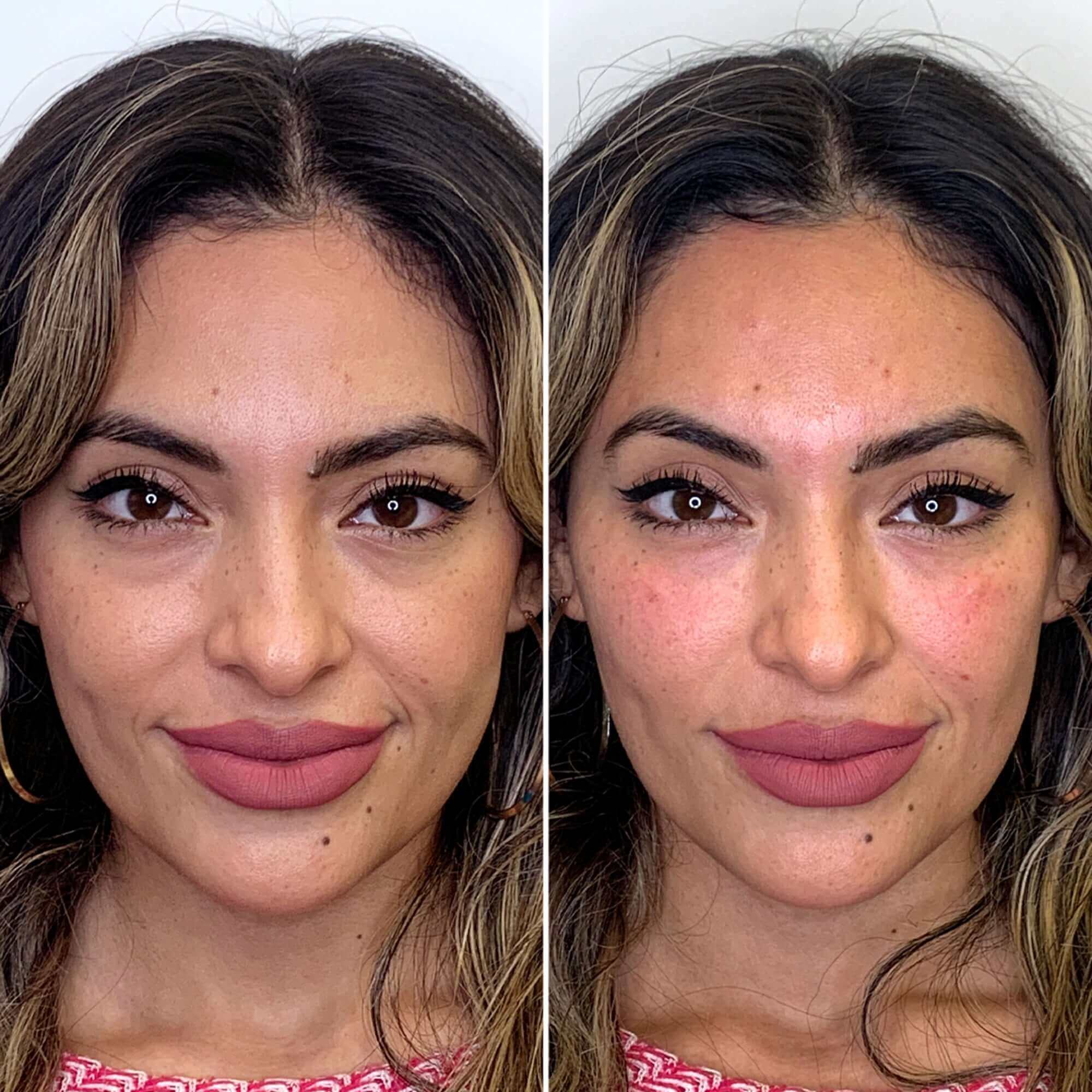CheekFix: Filler – Beauty Fix MedSpa