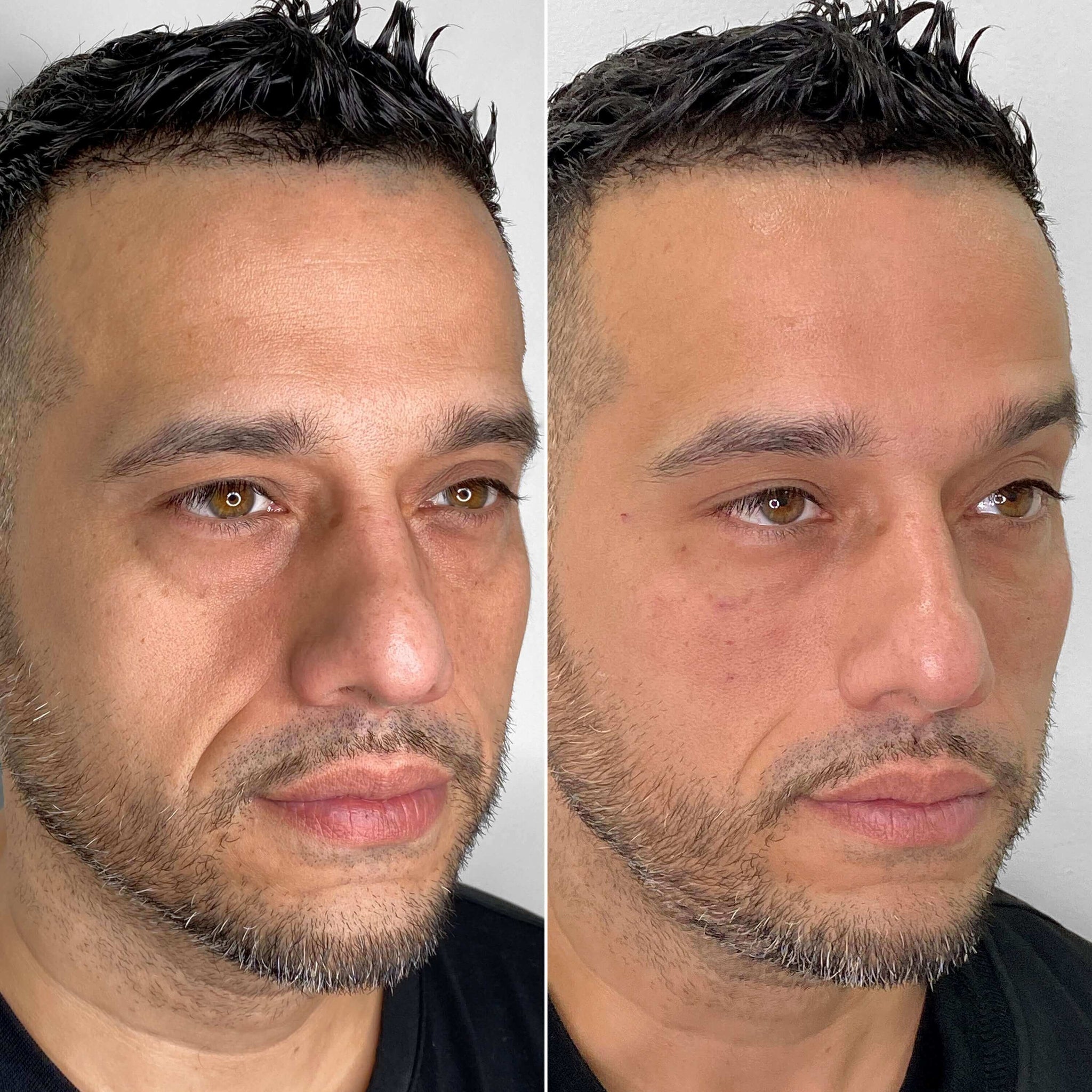 EyeFix: Filler – Beauty Fix MedSpa