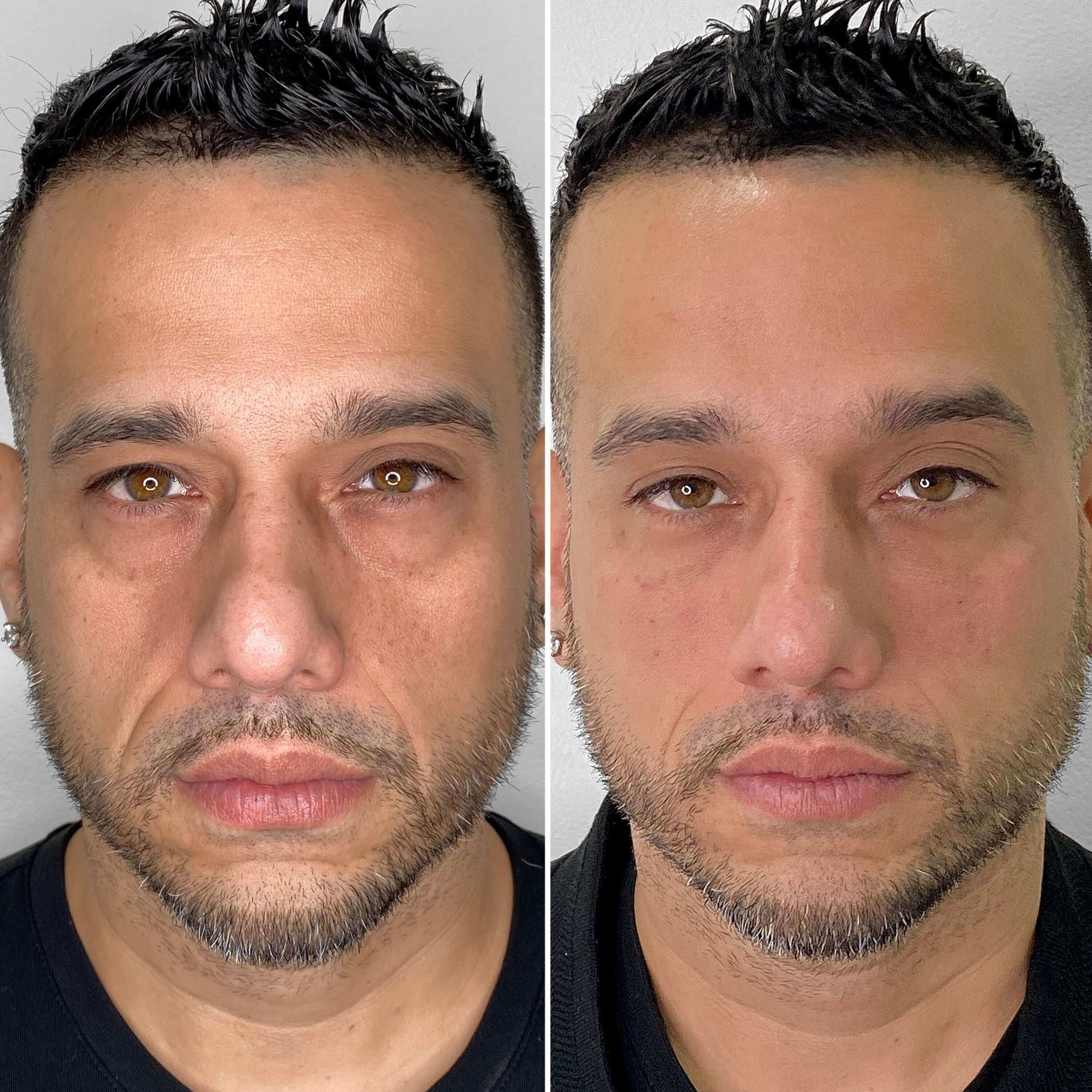 FaceFix: Face Lift for Men – Beauty Fix MedSpa