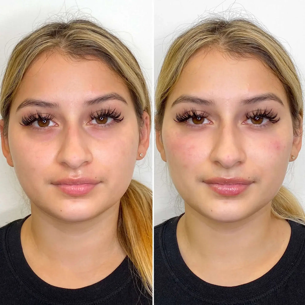 CheekFix: Filler – Beauty Fix MedSpa