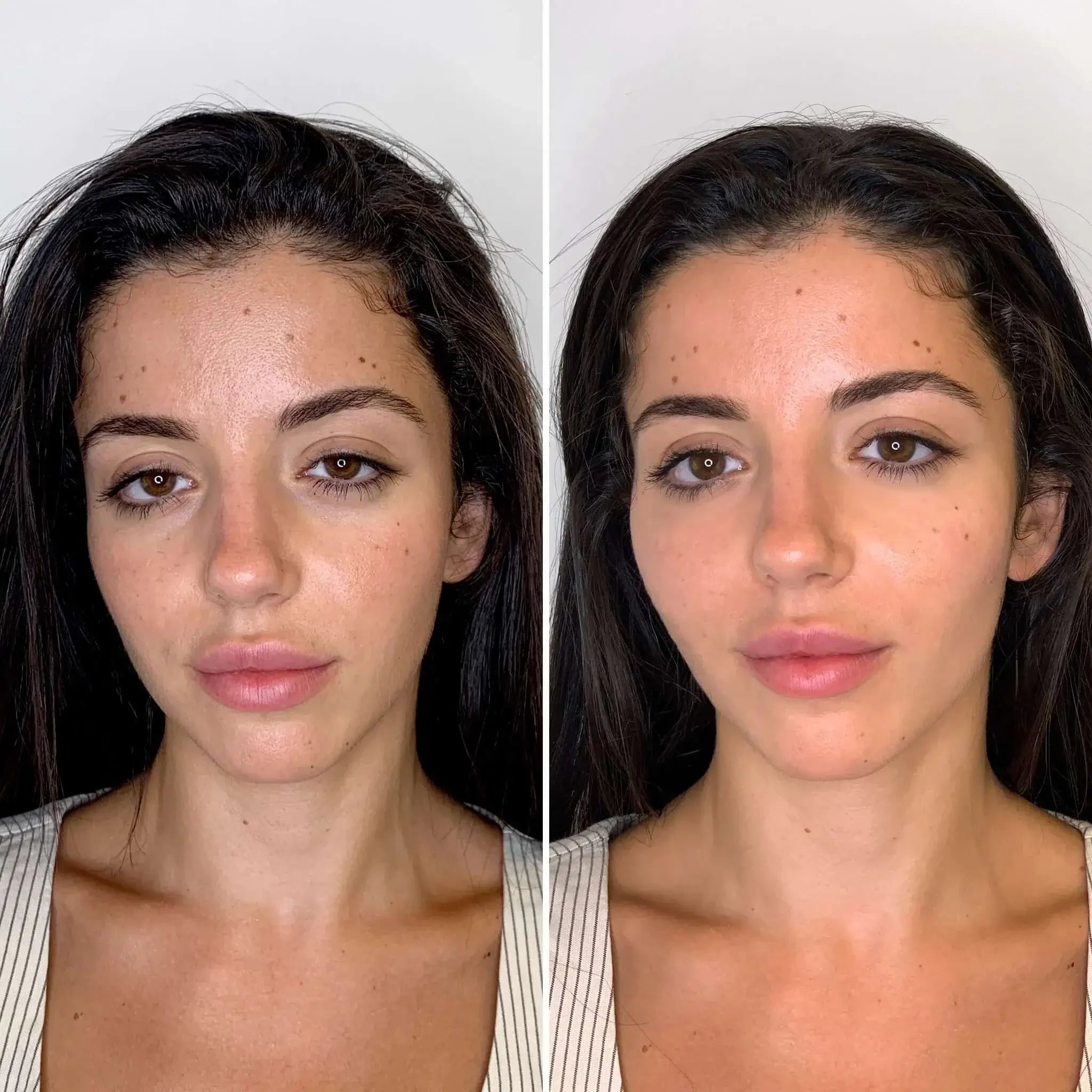 CheekFix: Filler – Beauty Fix MedSpa