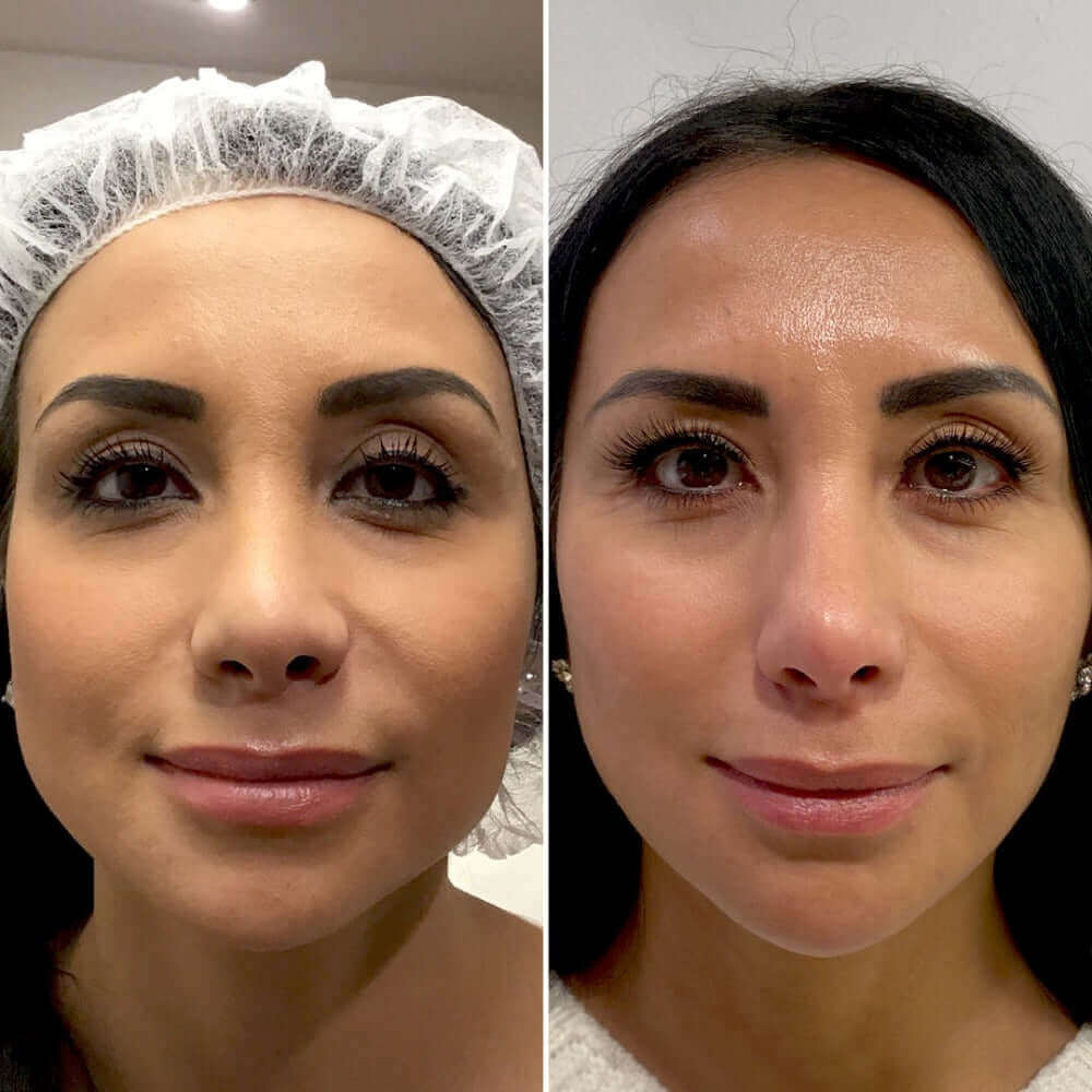 FaceFix: Sculptra – Beauty Fix MedSpa