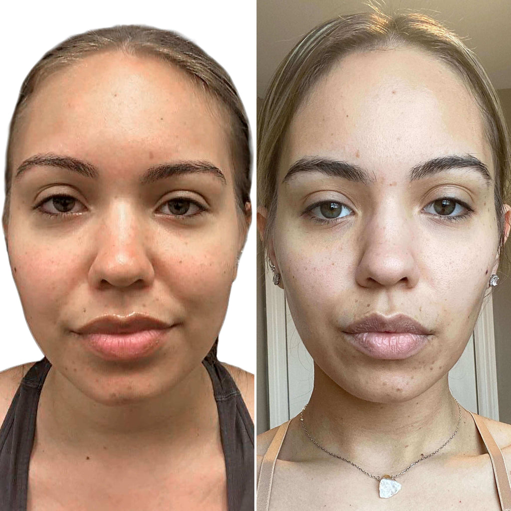 ChinFix: Liposuction – Beauty Fix MedSpa