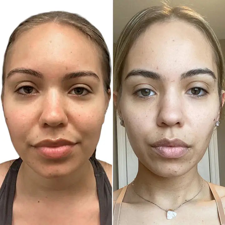 CheekFix: Buccal Fat Reduction – Beauty Fix MedSpa