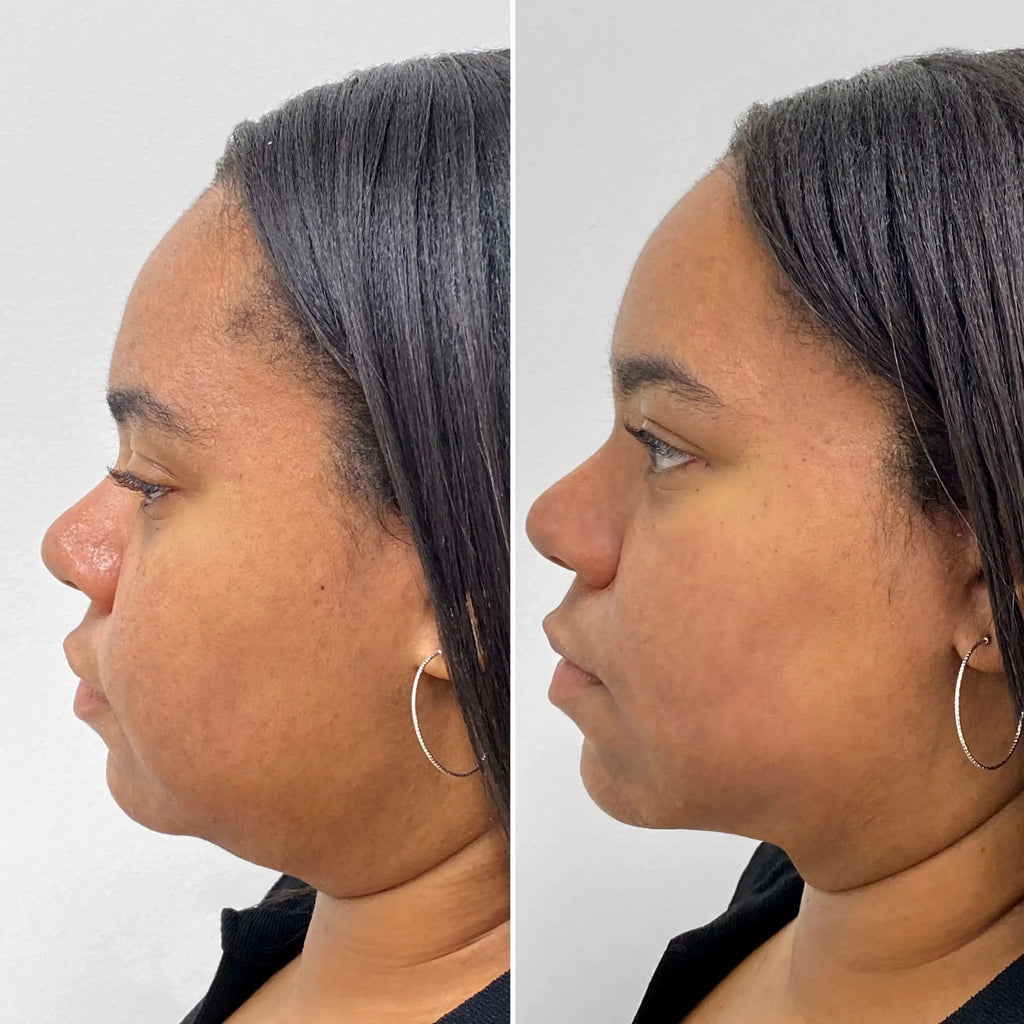 BodyFix: CoolSculpting® Elite – Beauty Fix MedSpa