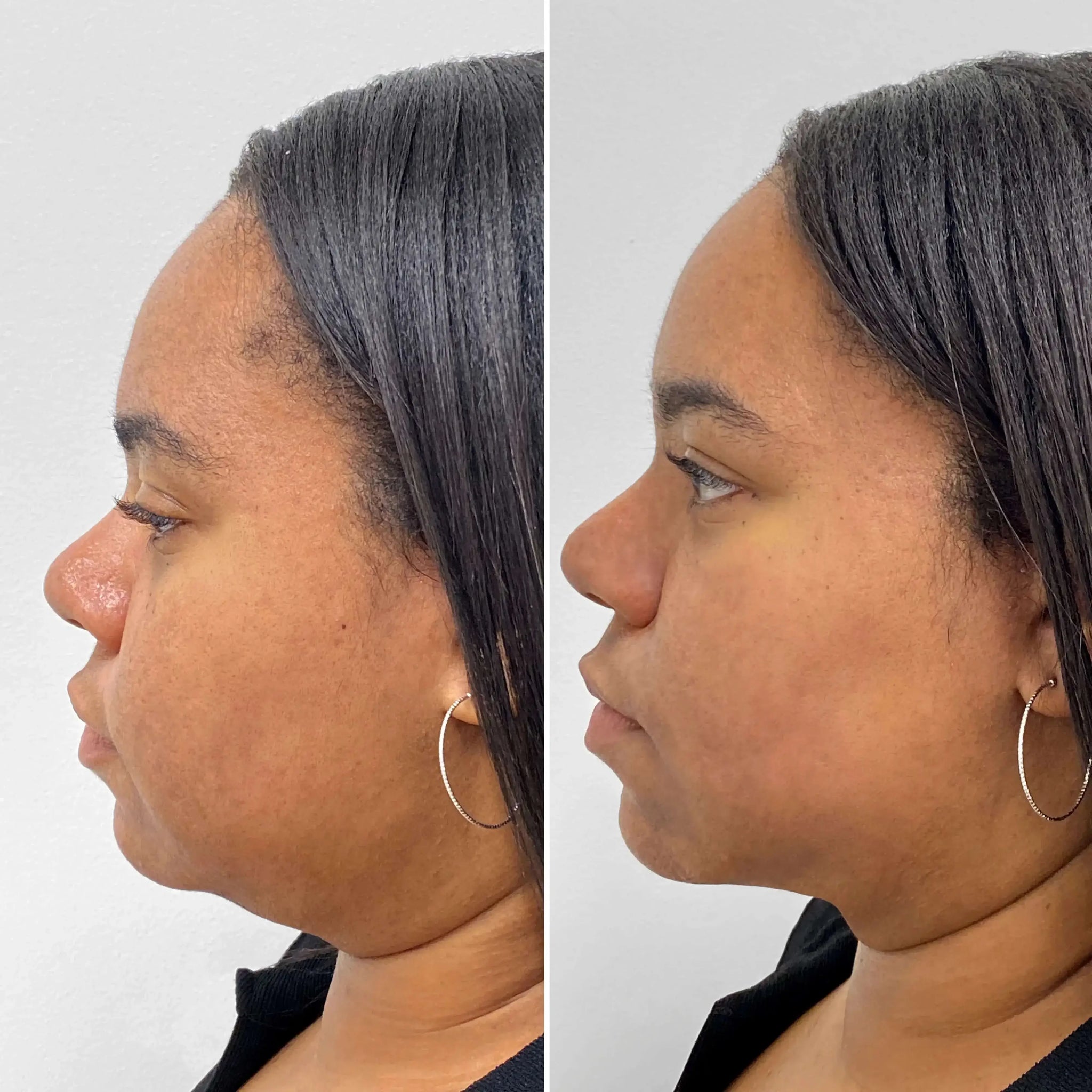 BodyFix: CoolSculpting® Elite – Beauty Fix MedSpa
