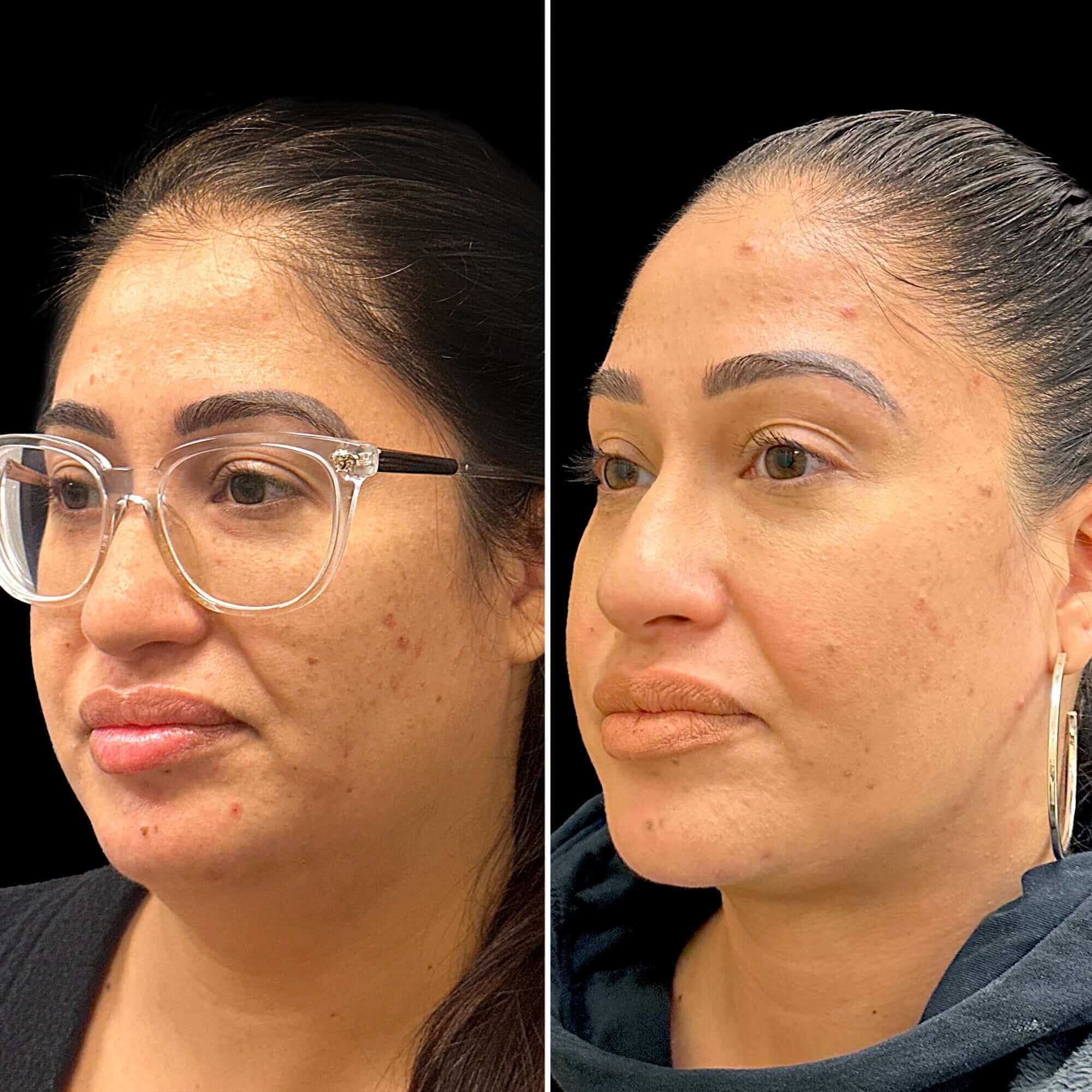 ChinFix: Liposuction – Beauty Fix MedSpa