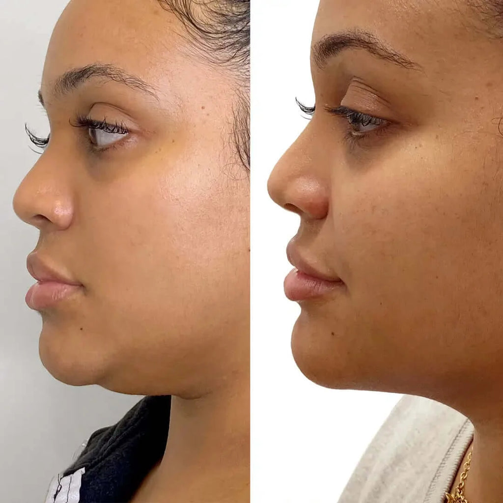ChinFix: Liposuction – Beauty Fix MedSpa