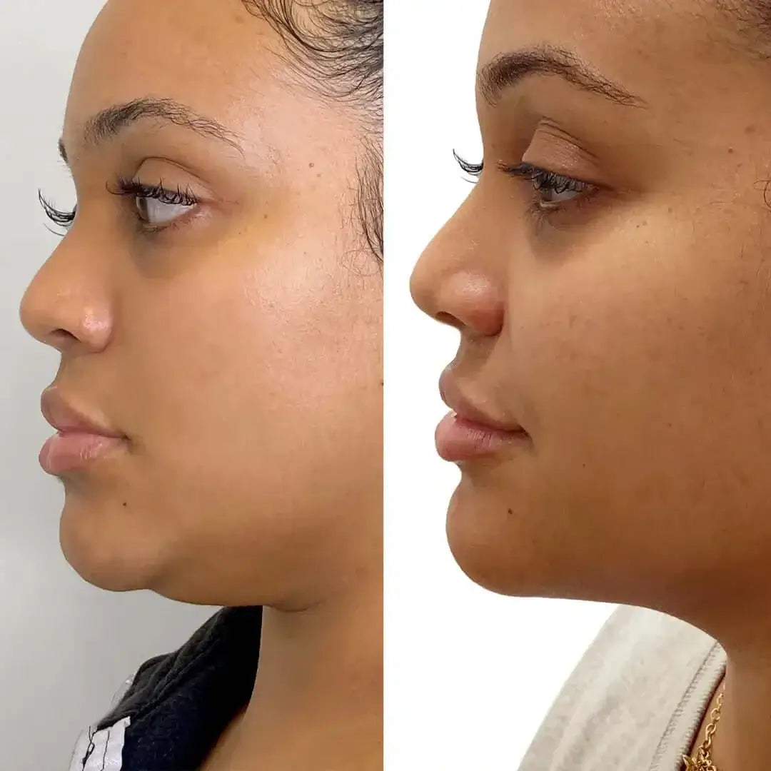 BodyFix: Liposuction – Beauty Fix MedSpa