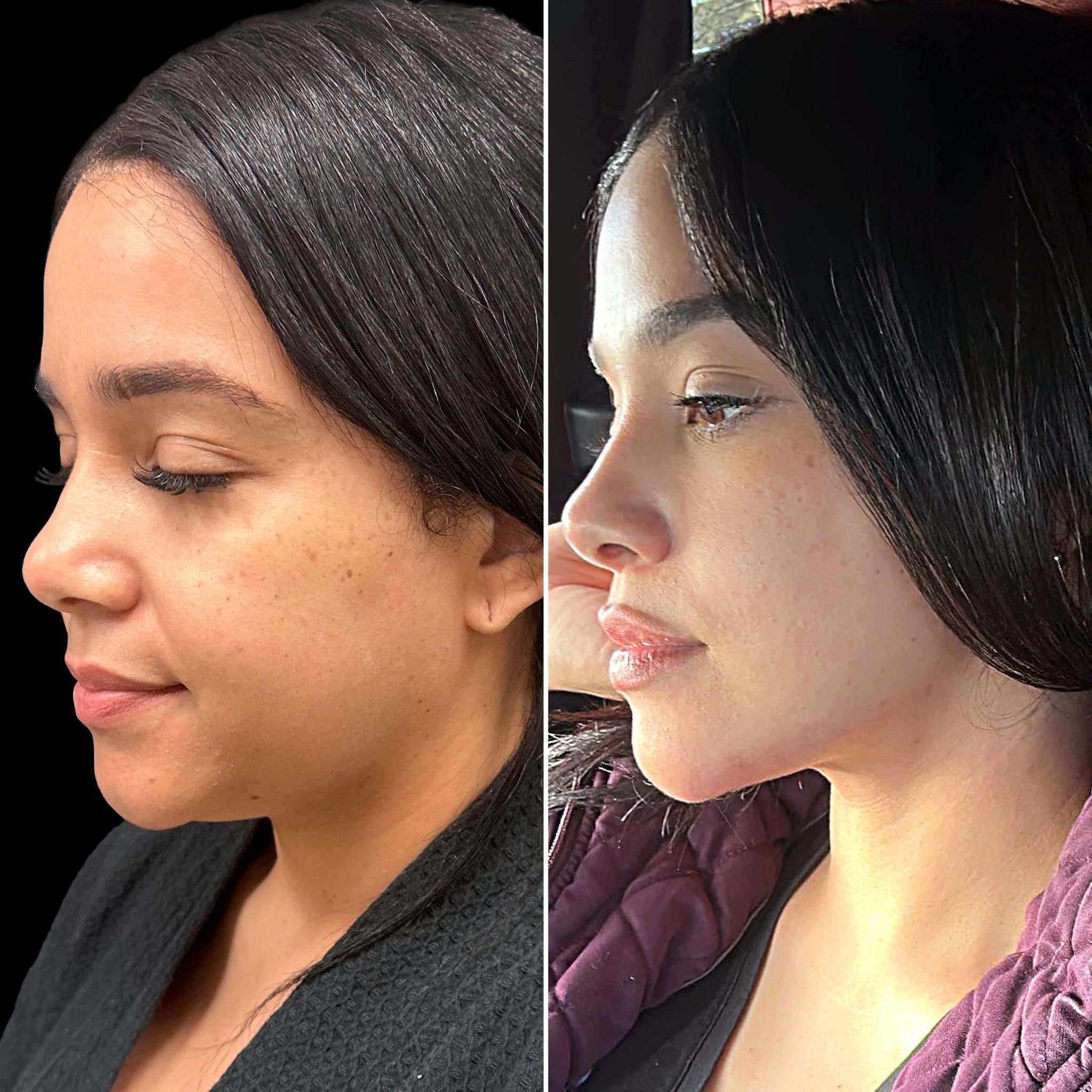 ChinFix: Liposuction – Beauty Fix MedSpa