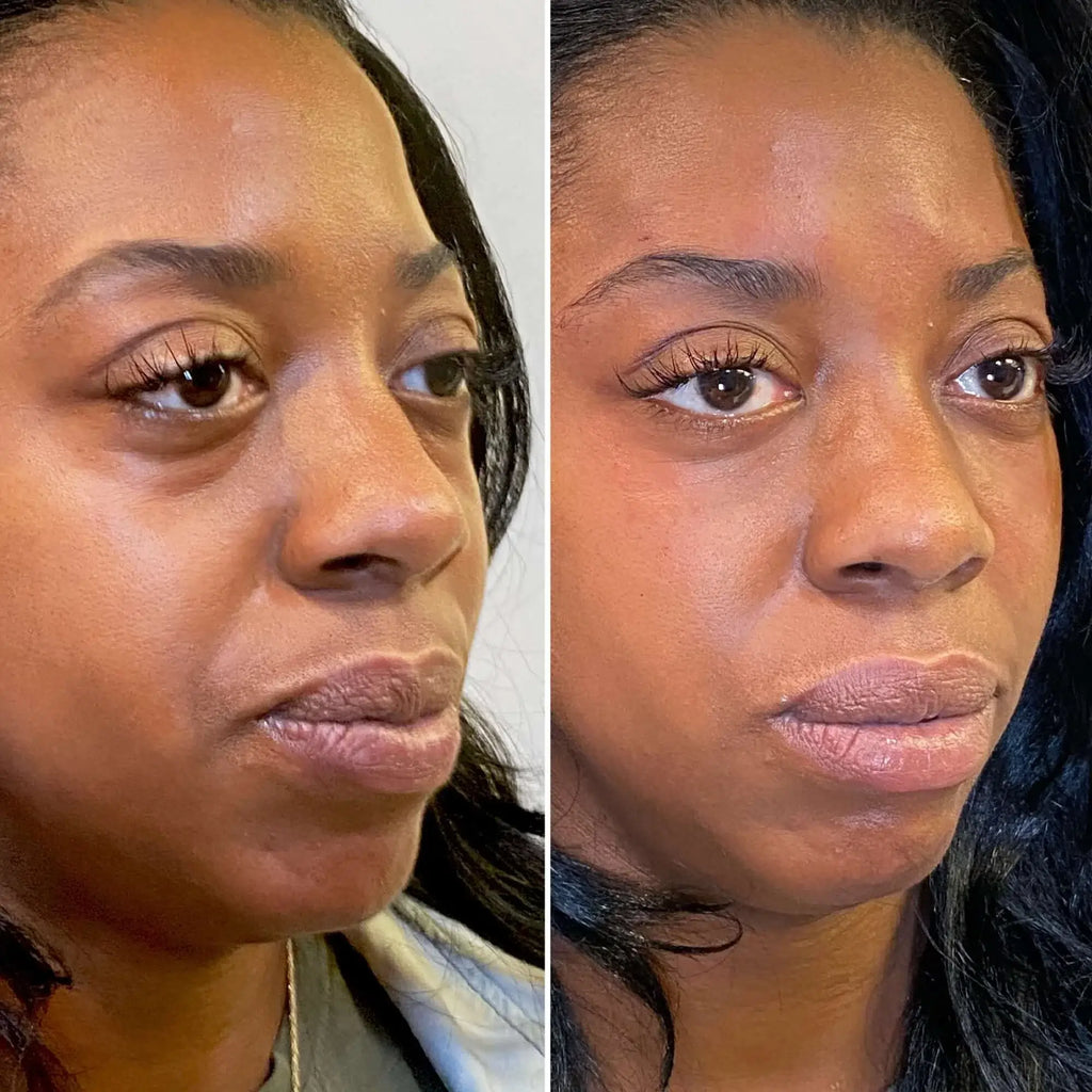 EyeFix: Filler – Beauty Fix MedSpa