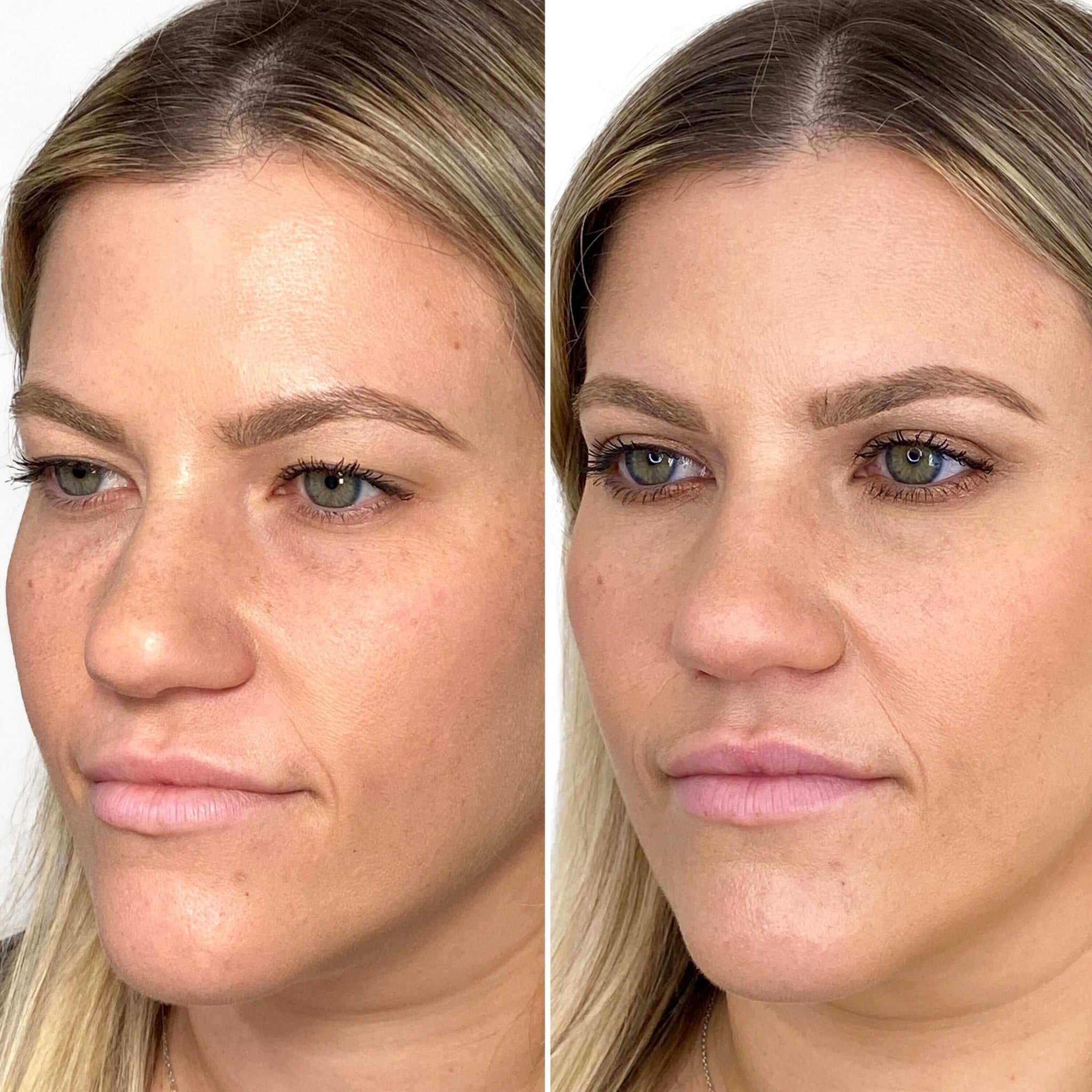 EyeFix: Upper Blepharoplasty – Beauty Fix MedSpa