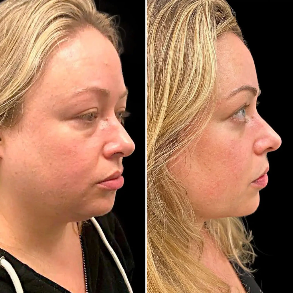 EyeFix: Upper Blepharoplasty – Beauty Fix MedSpa