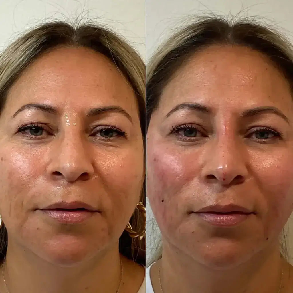 FaceFix: Thread Lift – Beauty Fix MedSpa