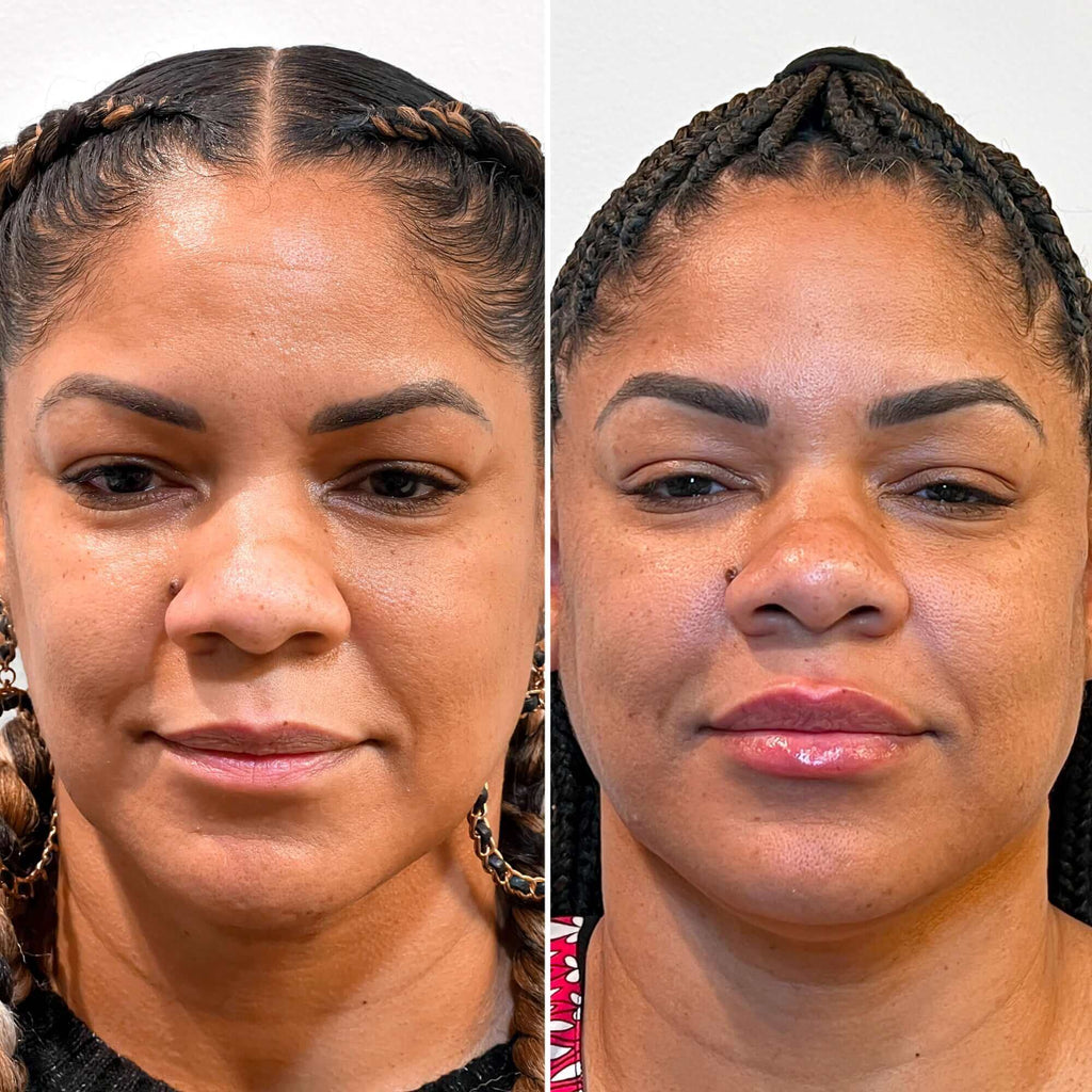 FaceFix: Thread Lift – Beauty Fix MedSpa