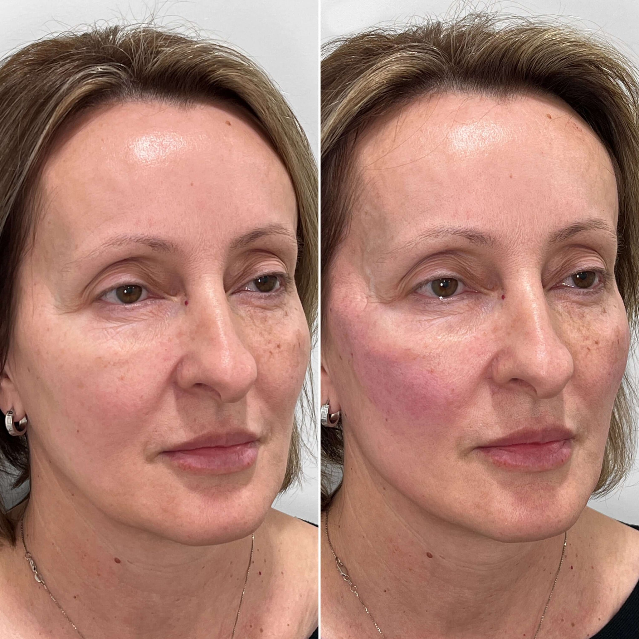 FaceFix: Thread Lift – Beauty Fix MedSpa