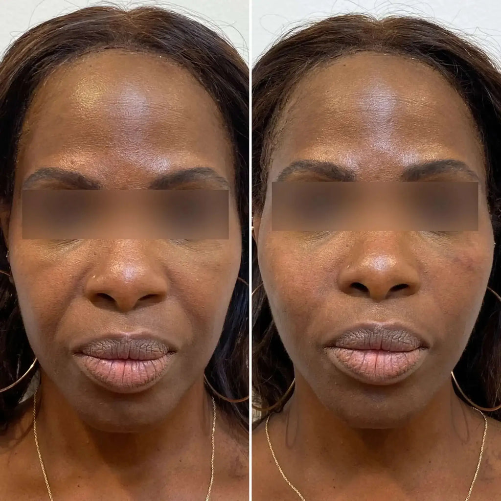 FaceFix: Thread Lift – Beauty Fix MedSpa