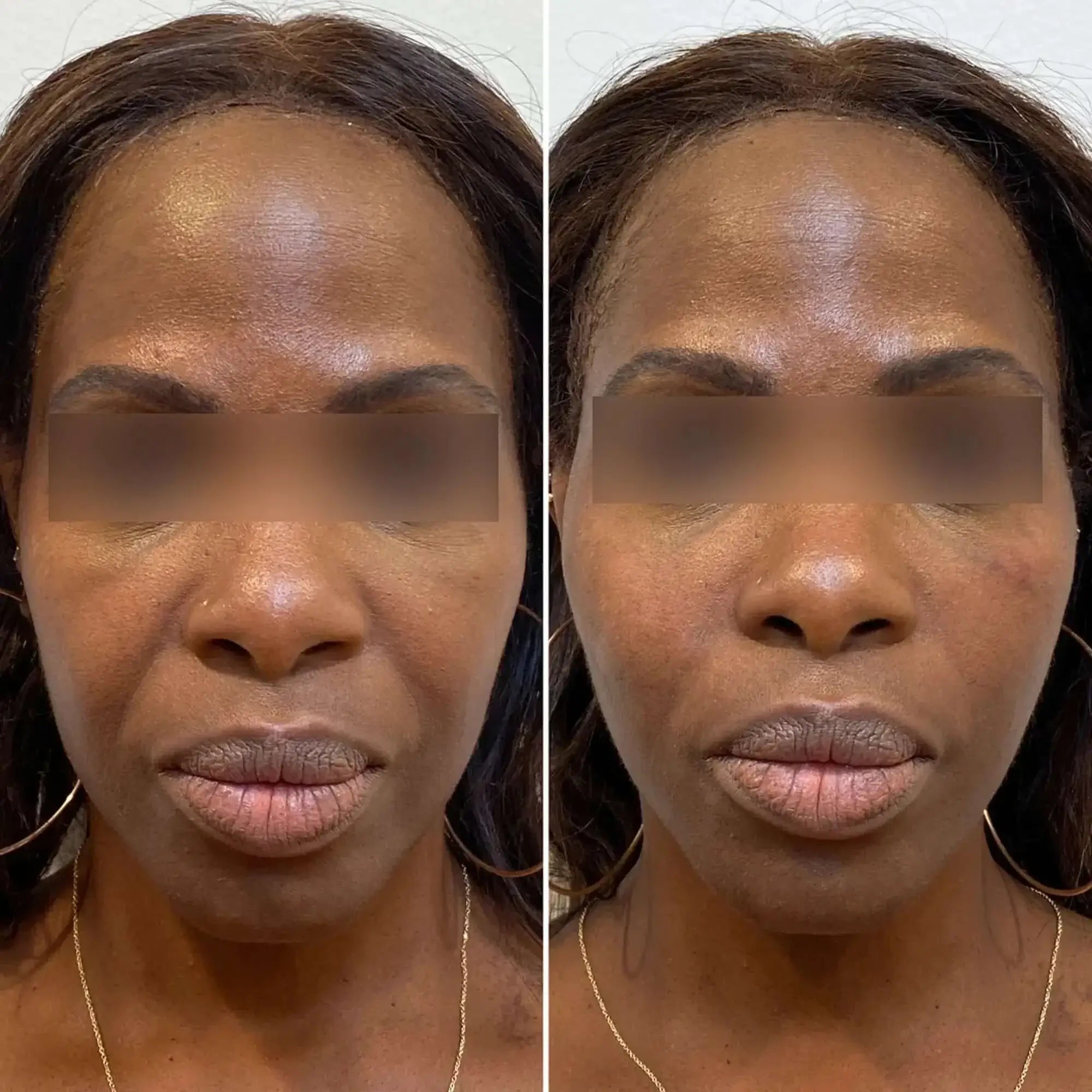 FaceFix: Thread Lift – Beauty Fix MedSpa