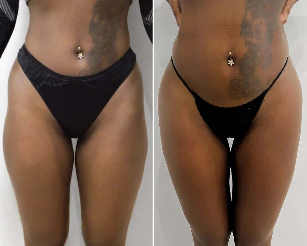 Enhance Me - Permanent Cosmetics & Aesthetics - Hip Dip Filler🍑 A  specialist Dermal Filler is inserted via a cannula into the buttock towards  to hip area to reduce hip dips by