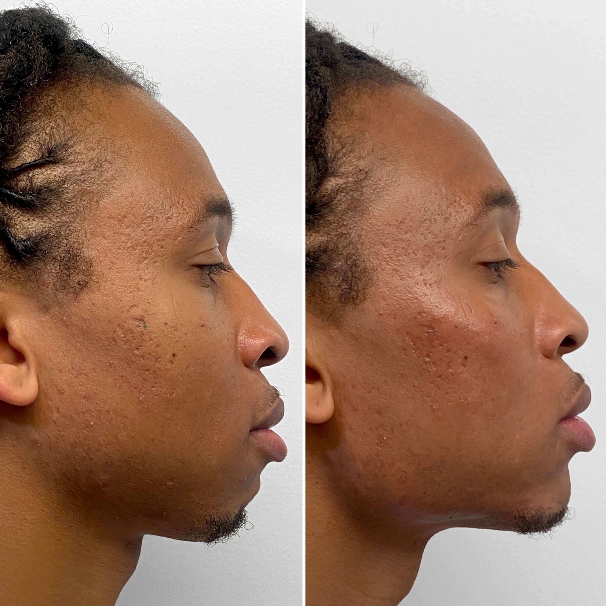 JawlineFix: Filler – Beauty Fix MedSpa