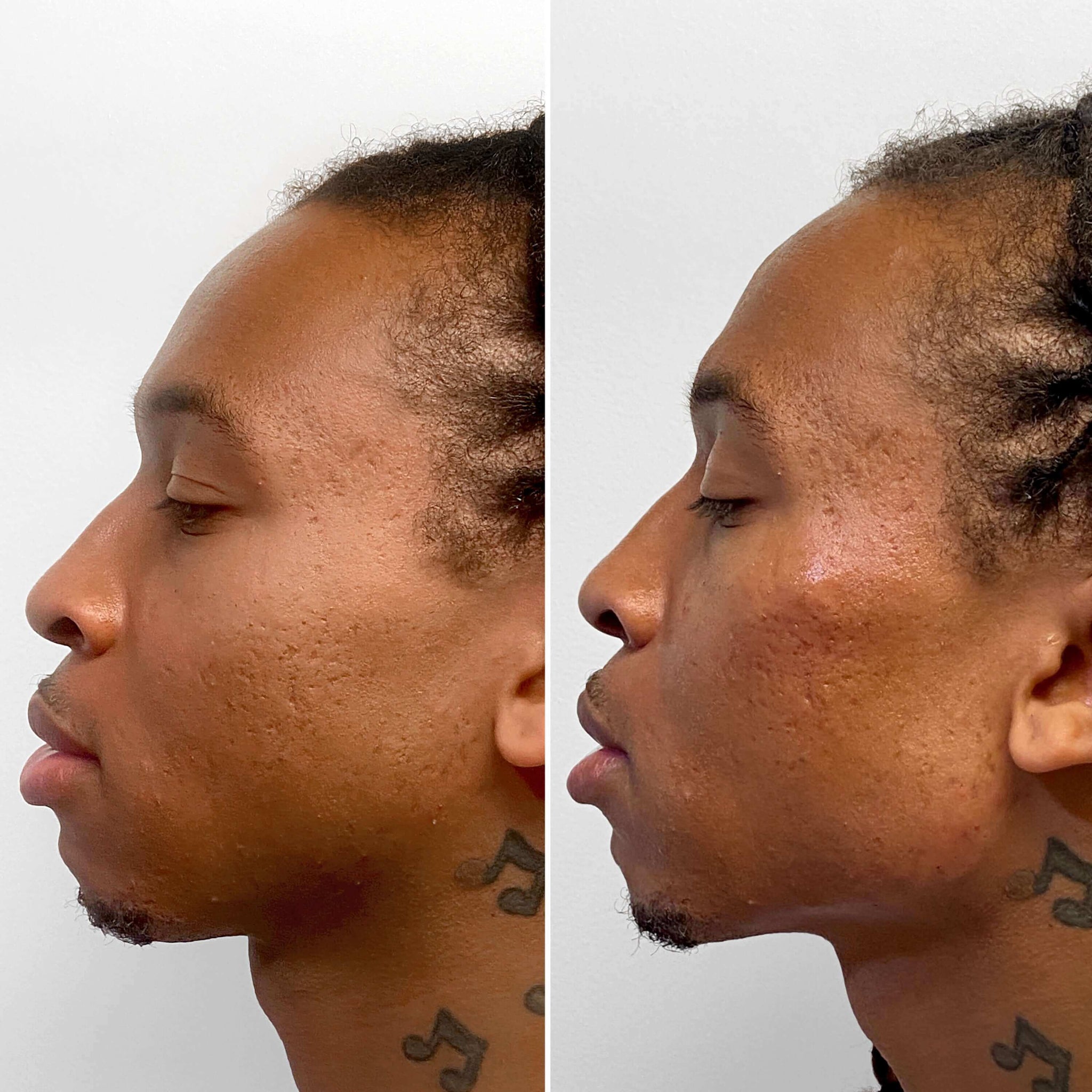 CheekFix: Filler – Beauty Fix MedSpa