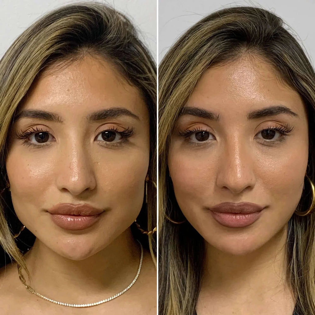 JawlineFix: Masseter Botox – Beauty Fix MedSpa