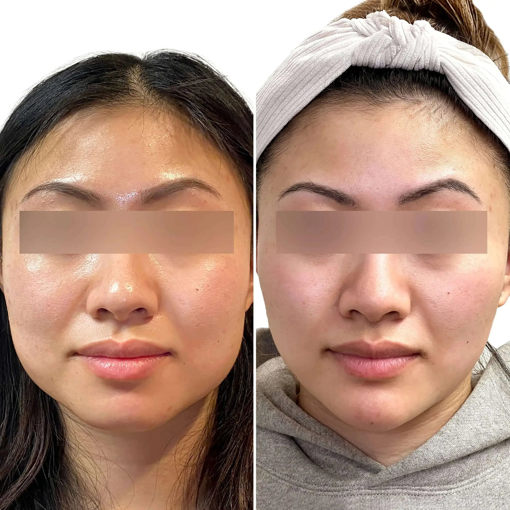 JawlineFix: Masseter Botox – Beauty Fix MedSpa