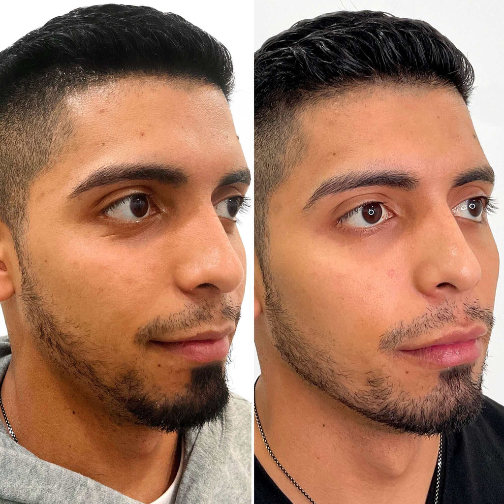 JawlineFix: Filler – Beauty Fix MedSpa