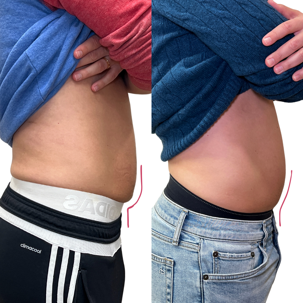 BodyFix: Kybella – Beauty Fix MedSpa