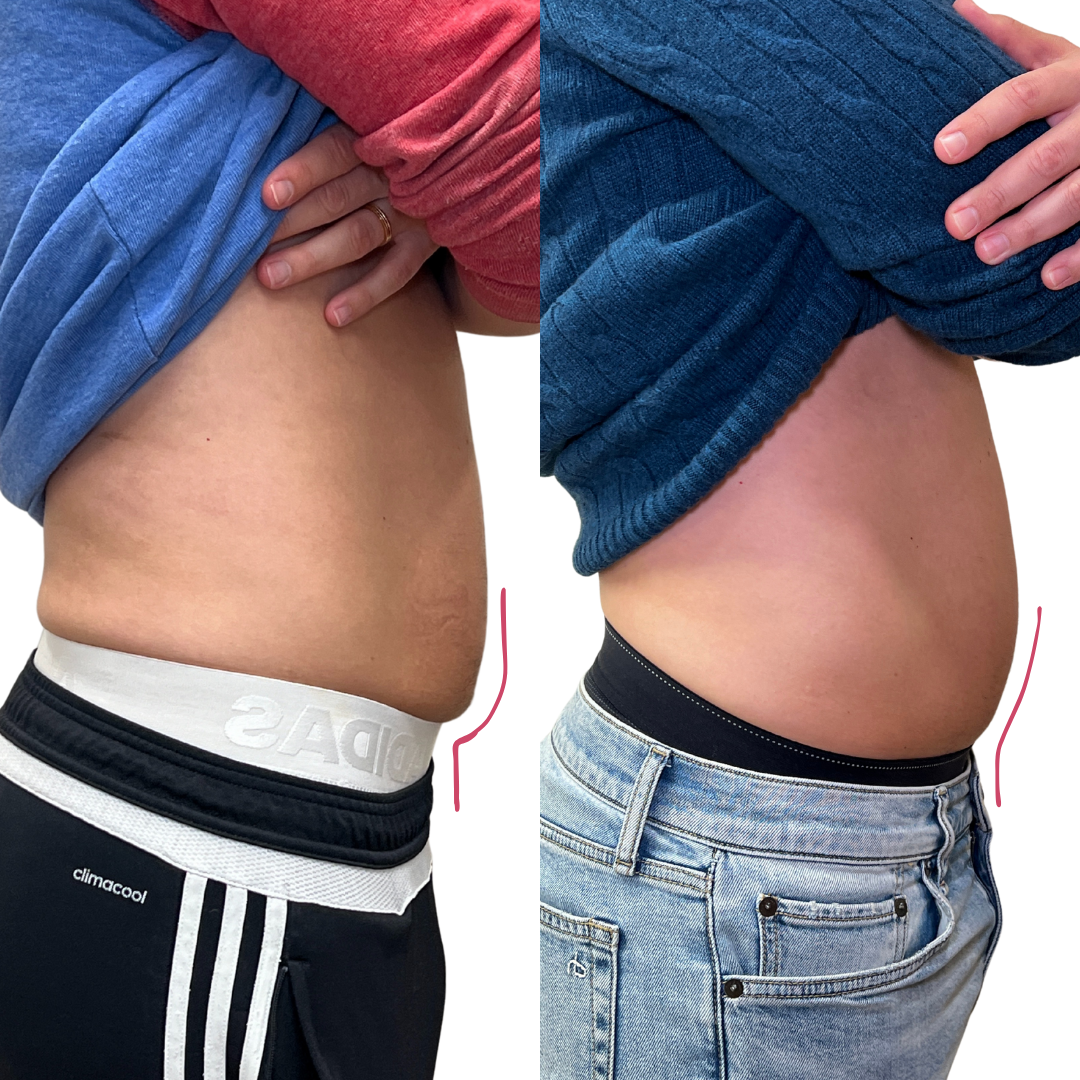 BodyFix: Kybella – Beauty Fix MedSpa
