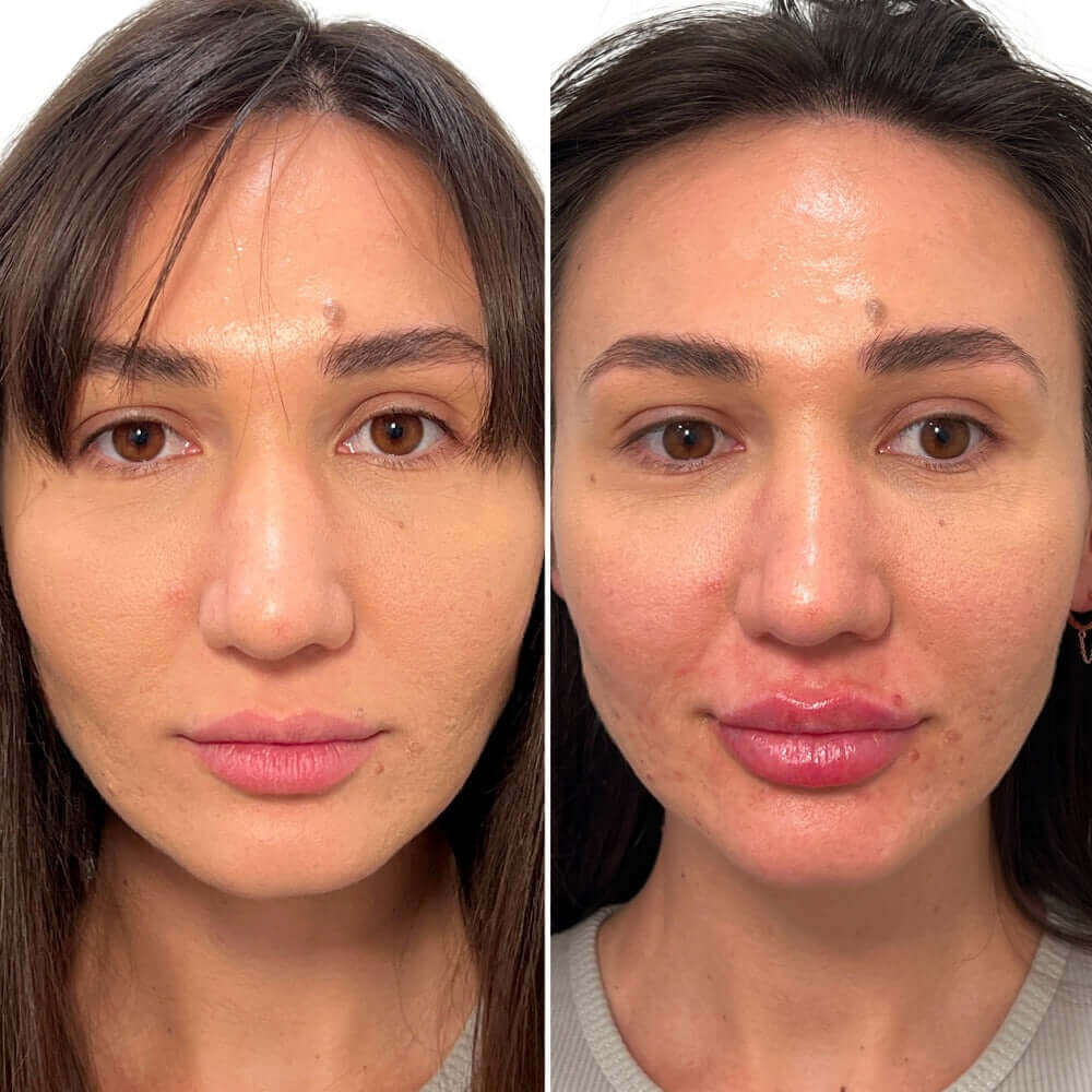 LipFix: Filler – Beauty Fix MedSpa