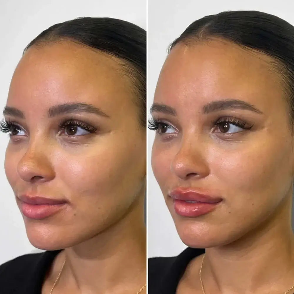 LipFix: Filler – Beauty Fix MedSpa