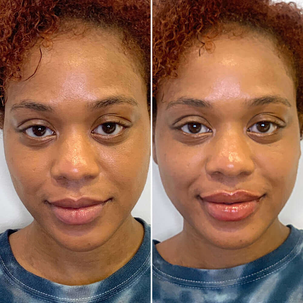 LipFix: Filler – Beauty Fix MedSpa
