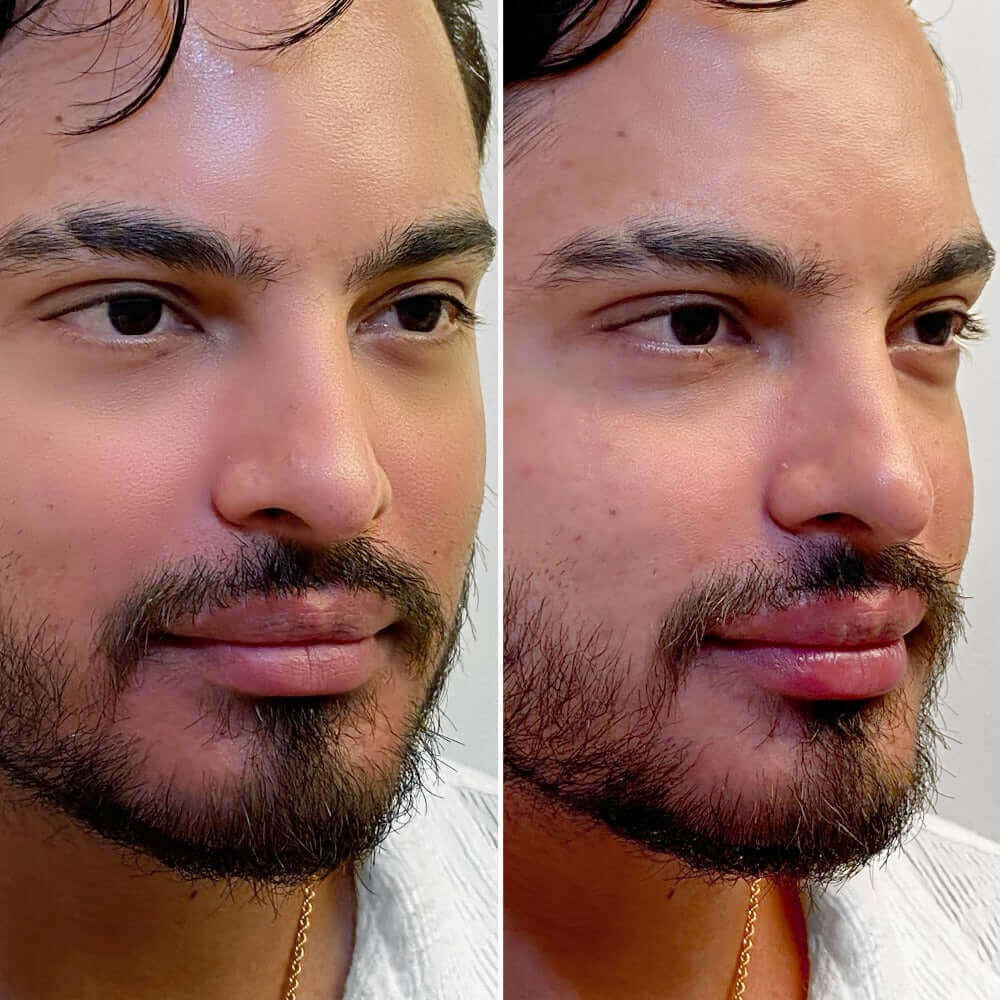 LipFix: Filler – Beauty Fix MedSpa