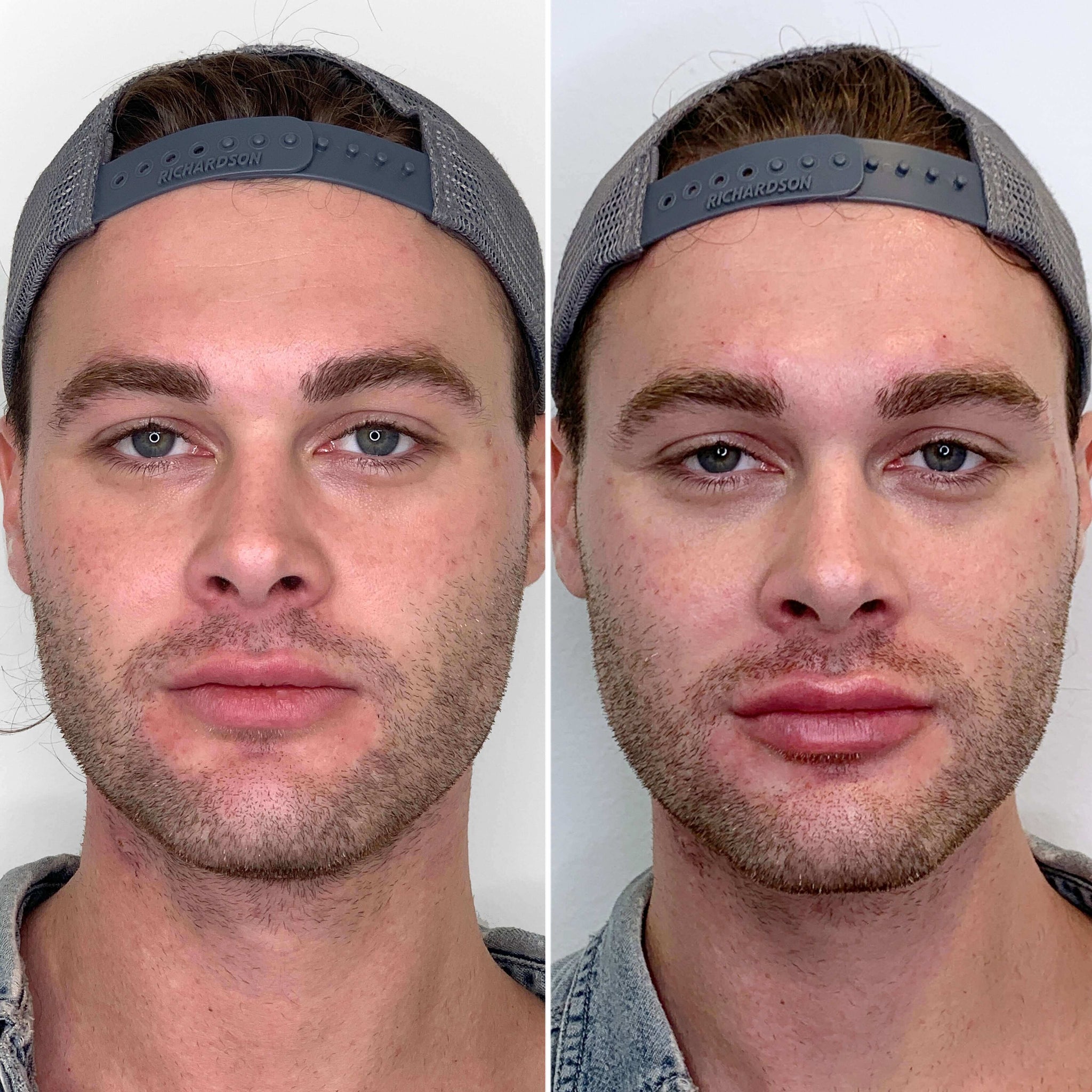 FaceFix: Face Lift for Men – Beauty Fix MedSpa