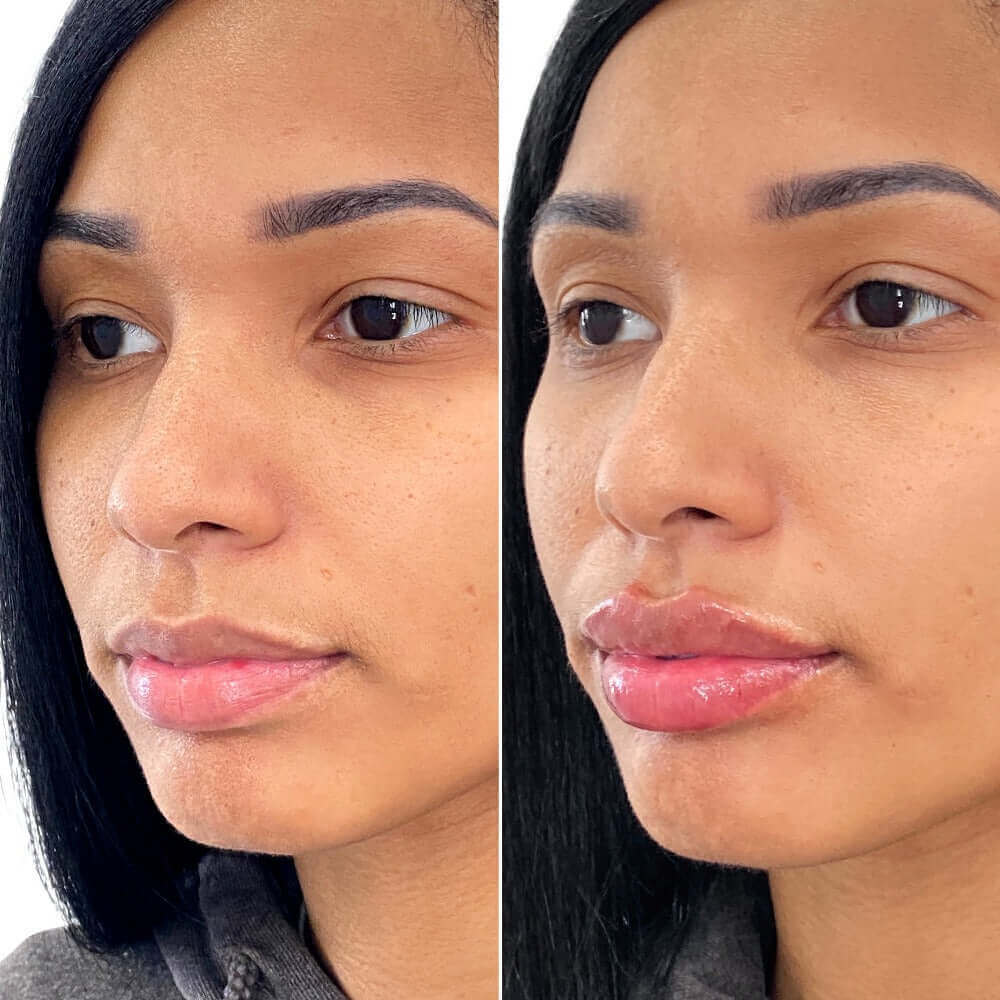 LipFix: Filler – Beauty Fix MedSpa