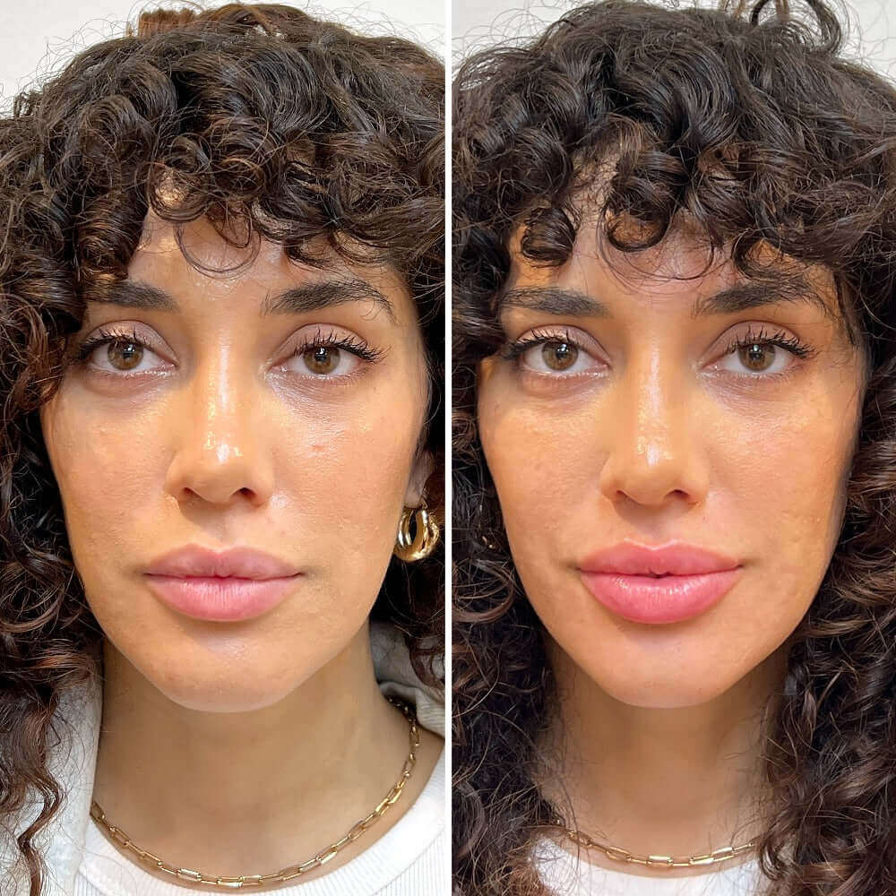 LipFix: Filler – Beauty Fix MedSpa