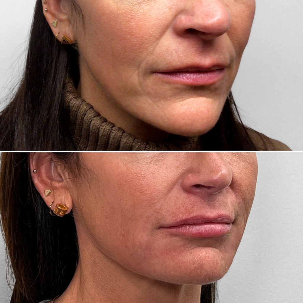 LipFix: Hydrate (SkinVive) – Beauty Fix MedSpa