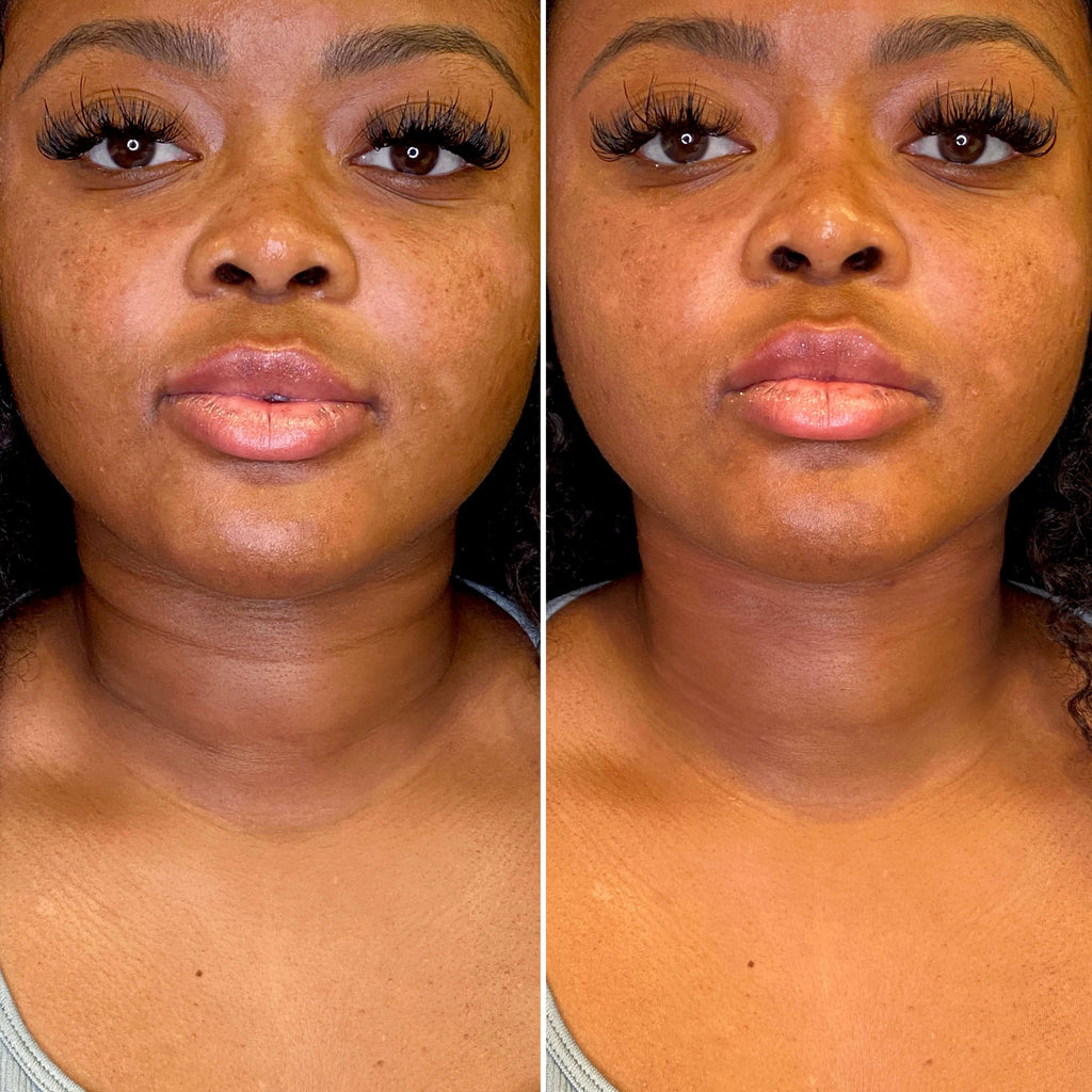 NeckFix: Filler – Beauty Fix MedSpa