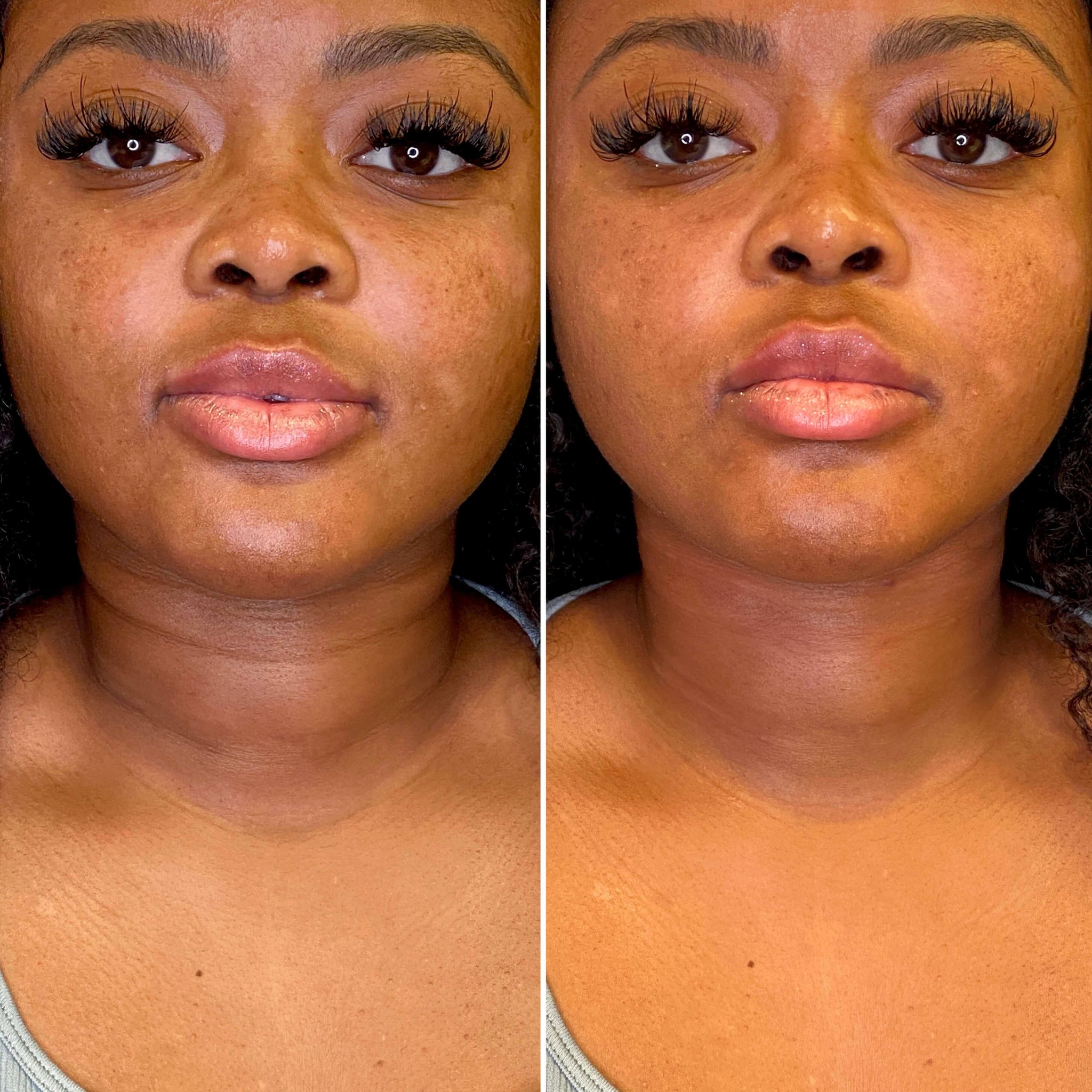 NeckFix: Filler – Beauty Fix MedSpa
