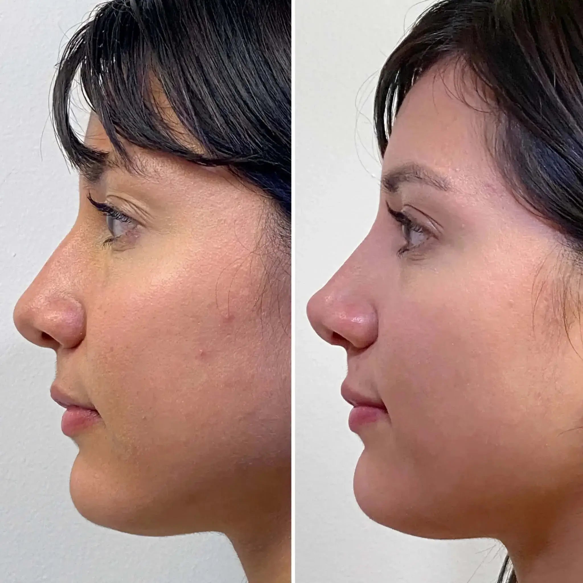 NoseFix: Filler – Beauty Fix MedSpa