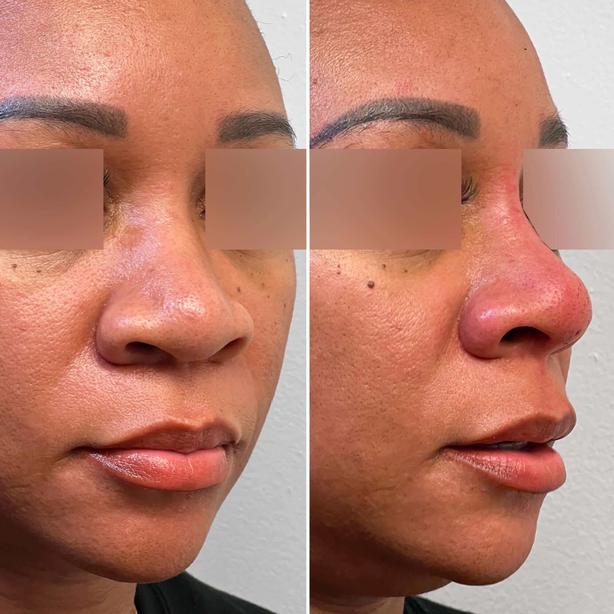 NoseFix: Threads – Beauty Fix MedSpa