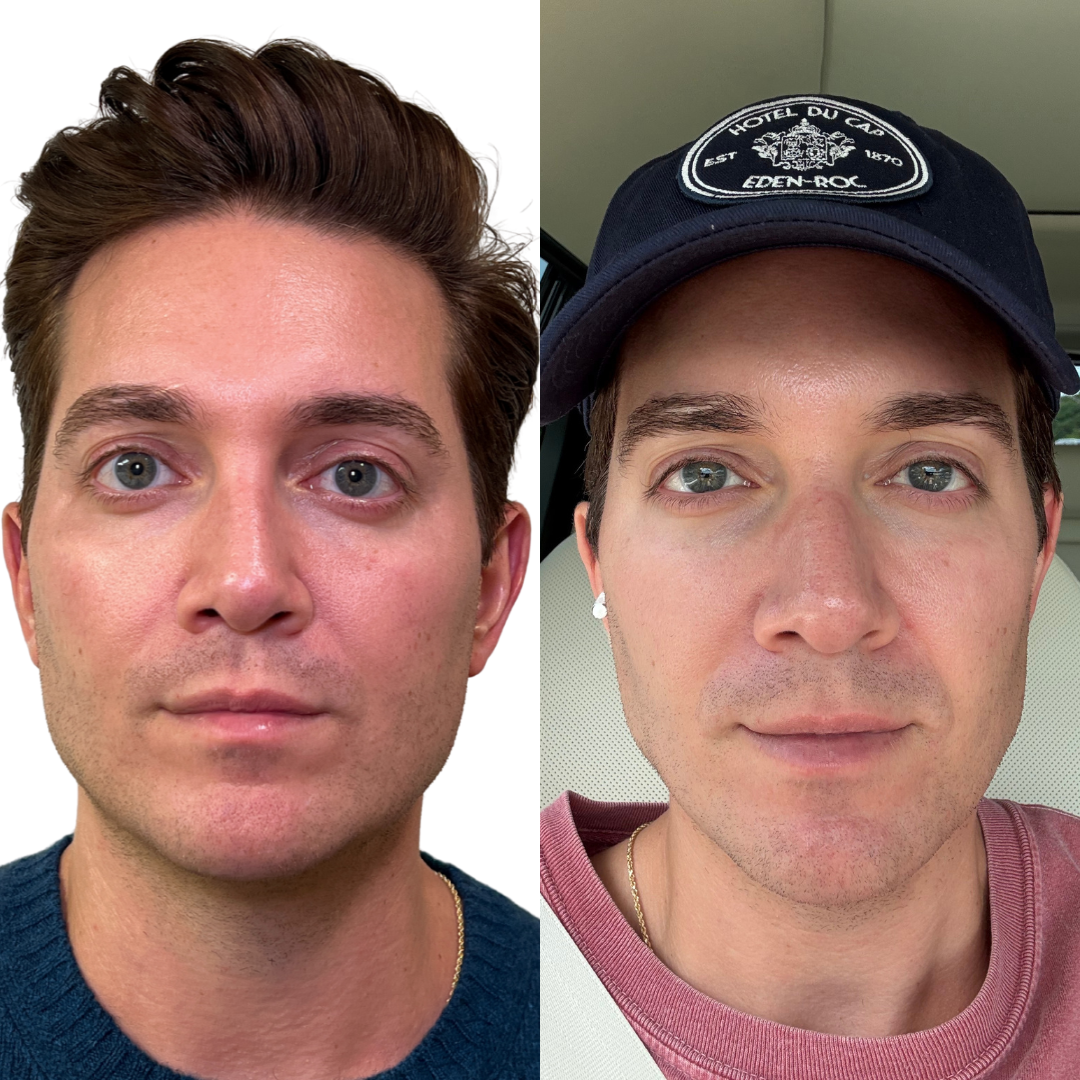SkinFix: Microneedling + PRF – Beauty Fix MedSpa